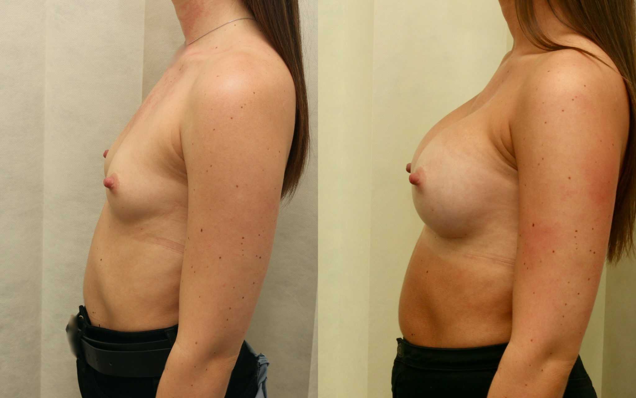 breast implants before and after