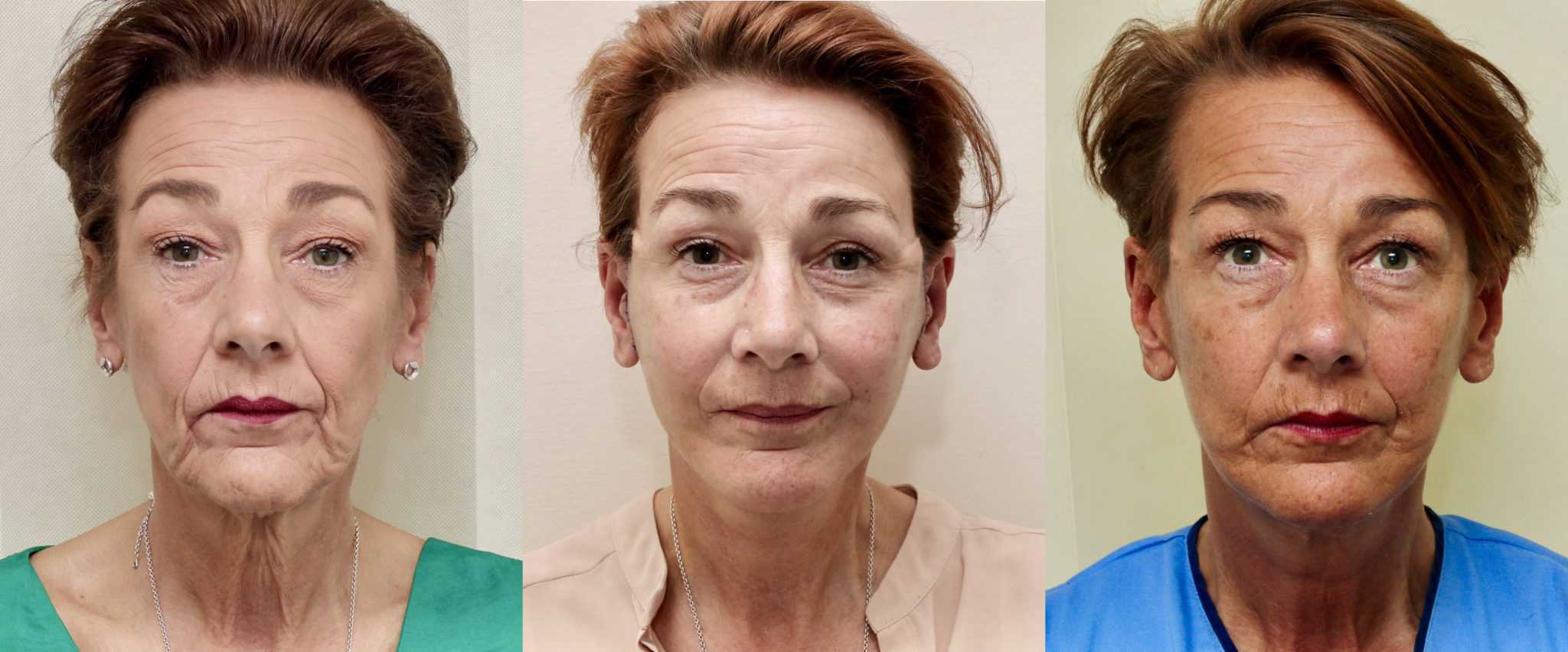 Before and after facelift, 6 days and 6 months post op