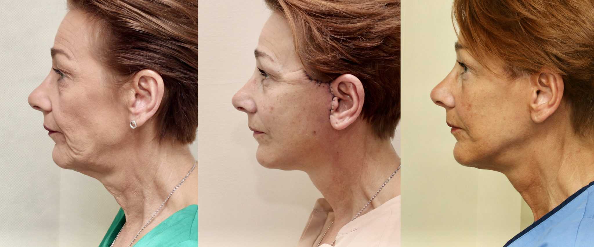 Before and after facelift, 6 days and 6 months post op