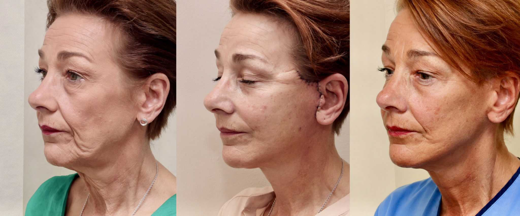Before and after facelift, 6 days and 6 months post op