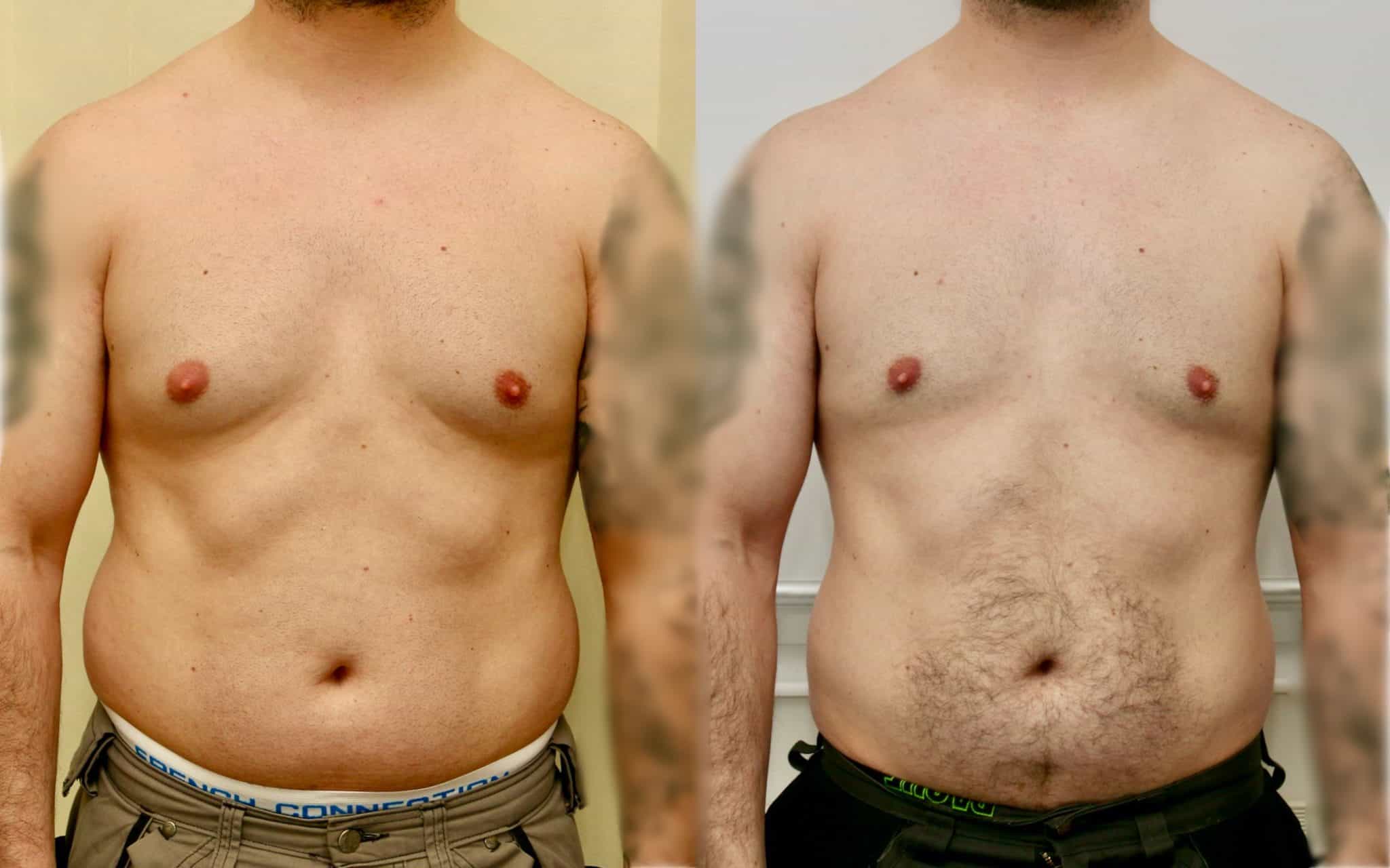 Gynecomastia liposuction before and after