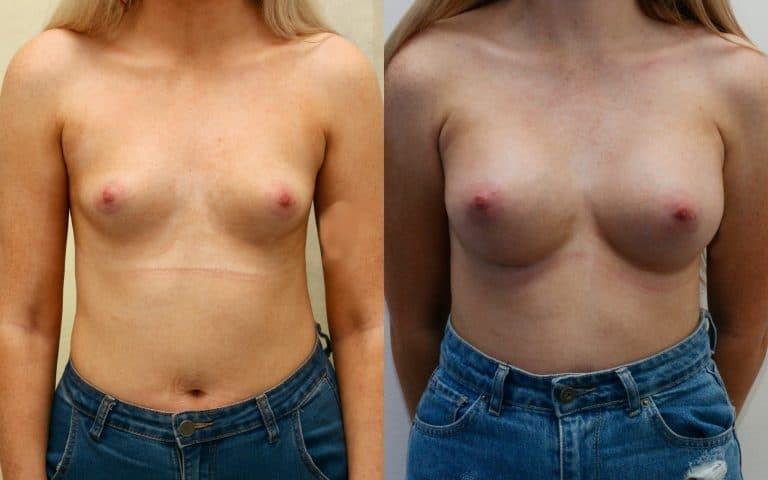 Breast augmentation, before and after, photo 1 of 6