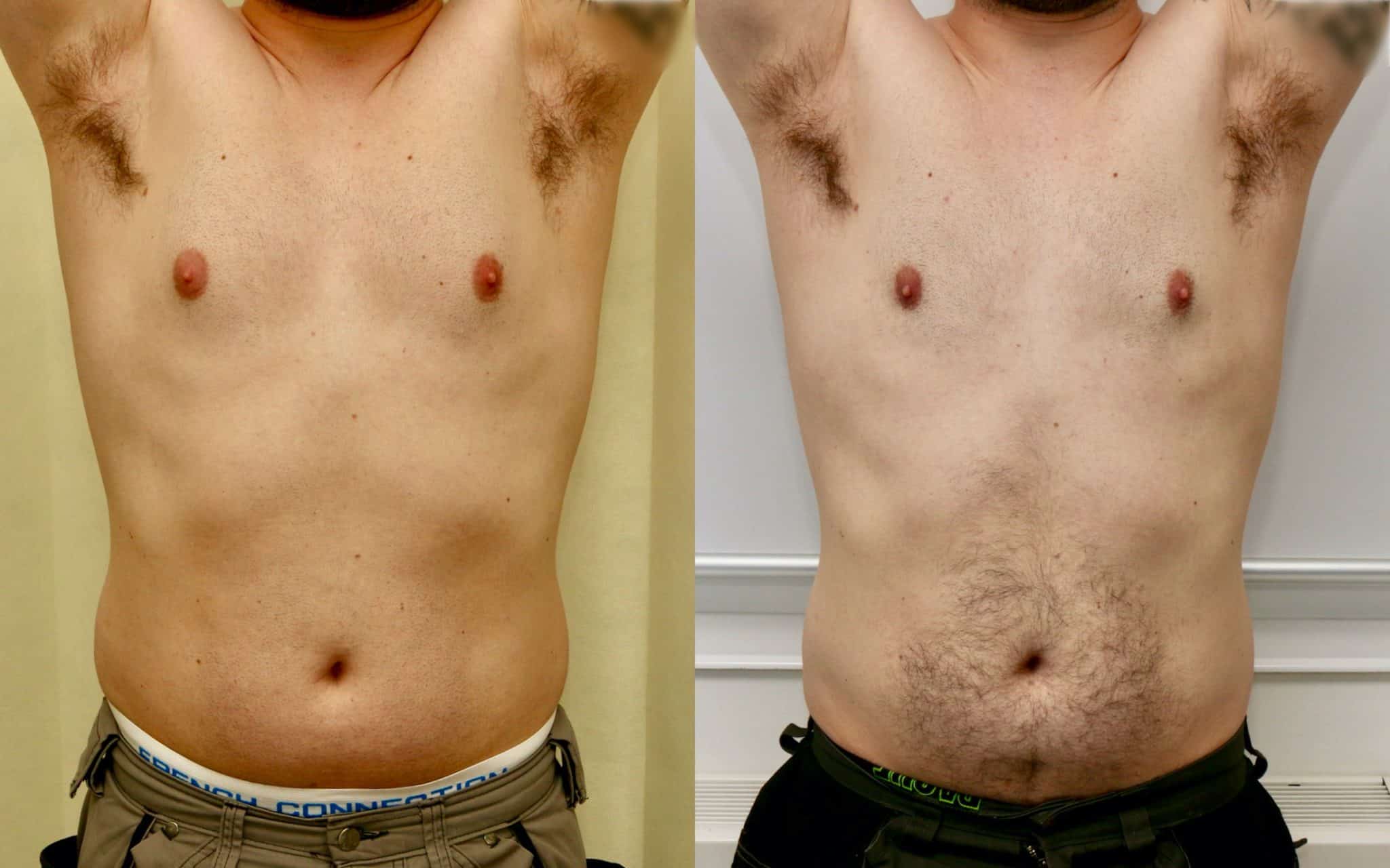 gynecomastia liposuction