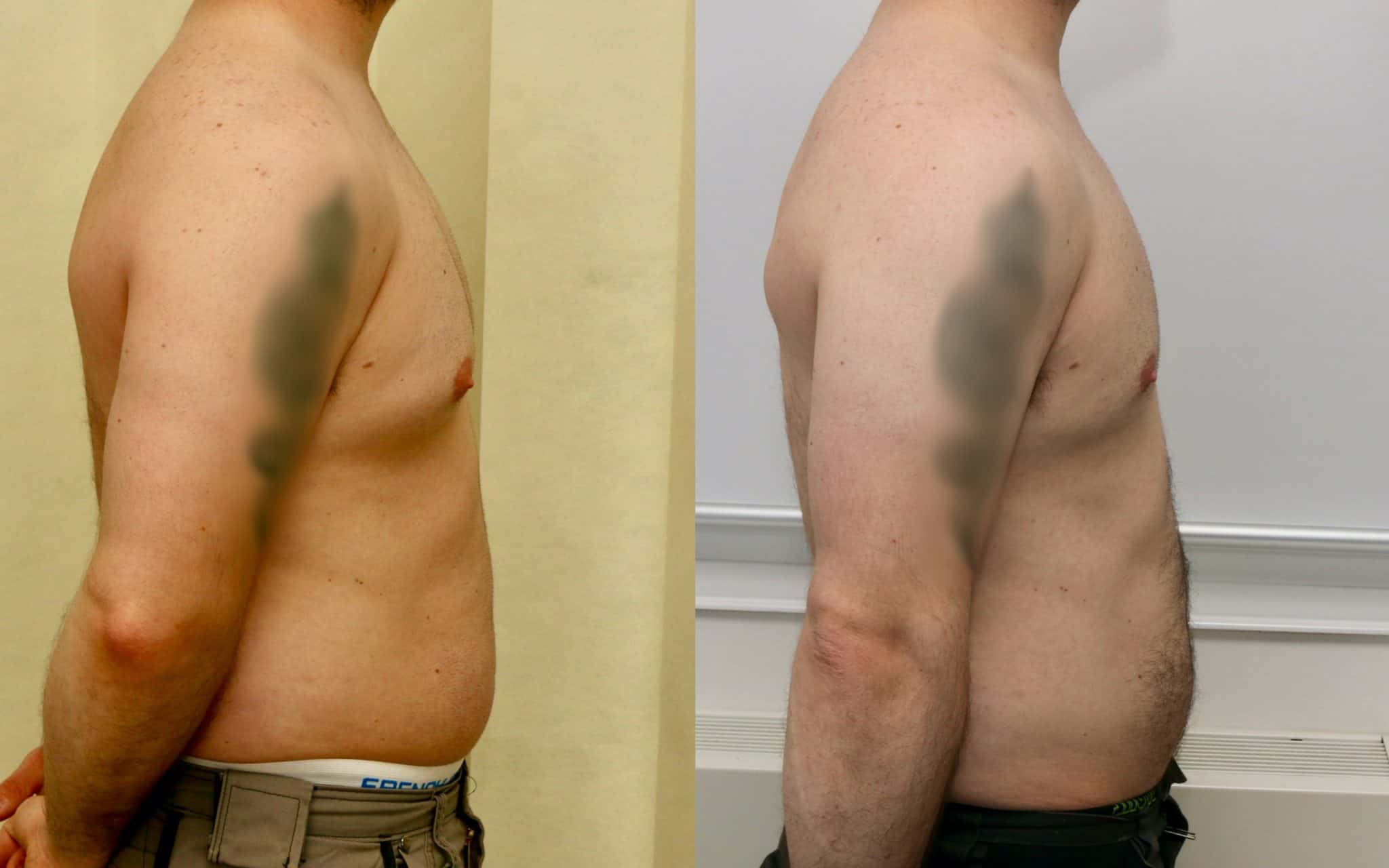 gynecomastia before and after