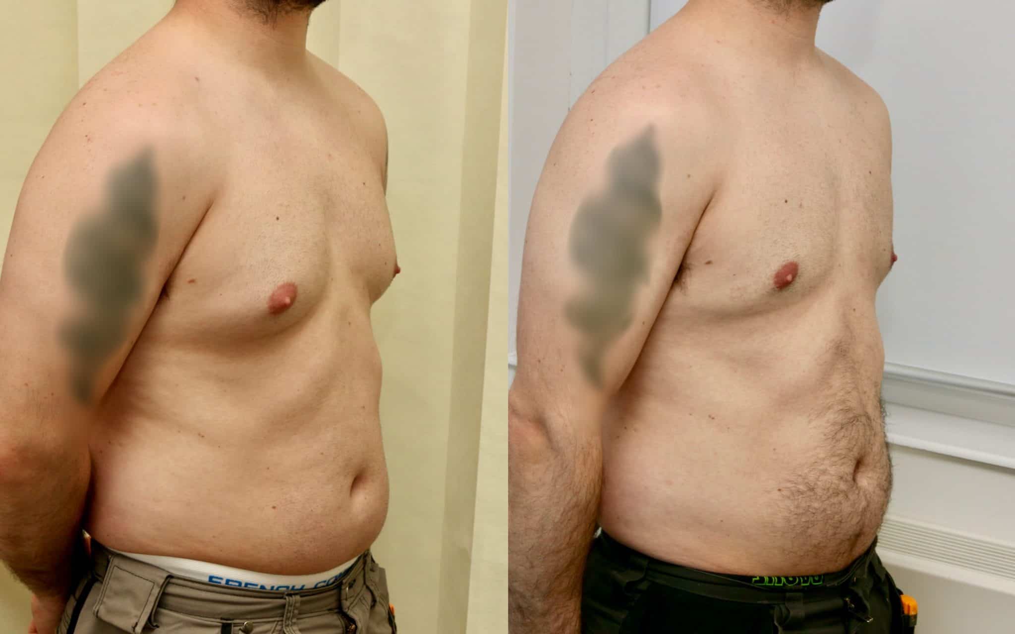 gynecomastia scotland