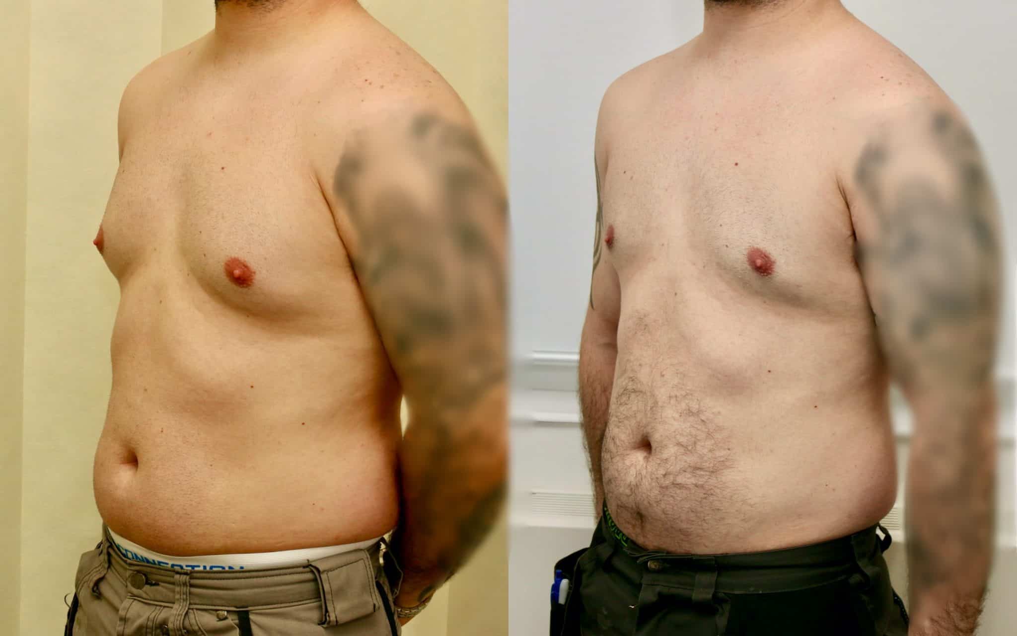 gynecomastia edinburgh