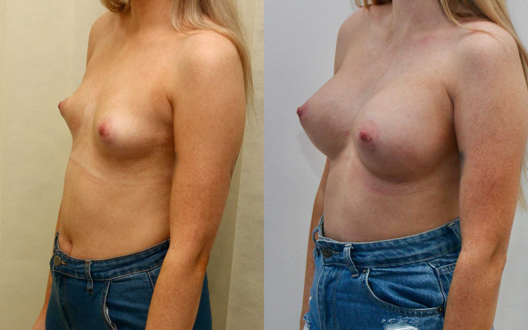 breast augmentation edinburgh