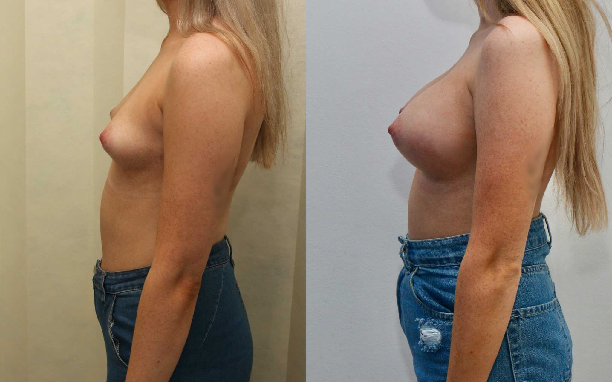 breast augmentation scotland