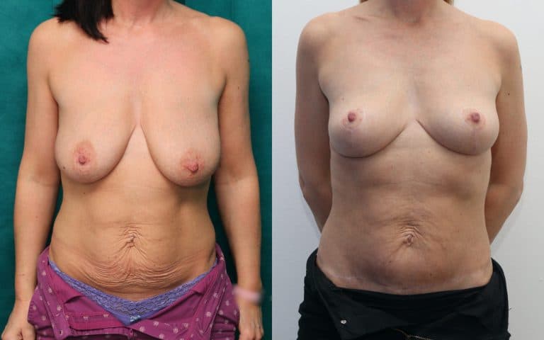 Mummy makeover before and after, case 19, photo 1 of 6