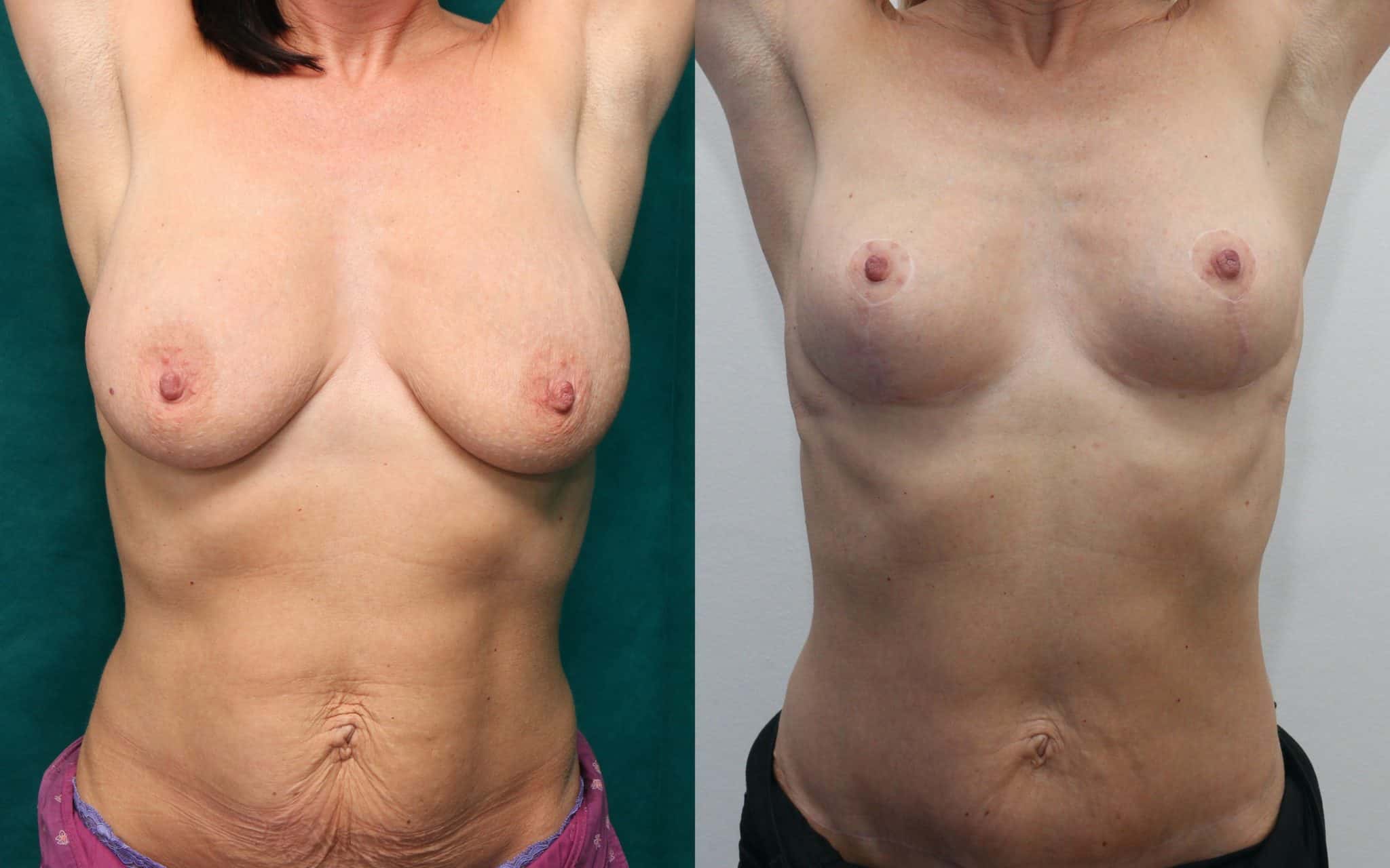 Breast lift skin only