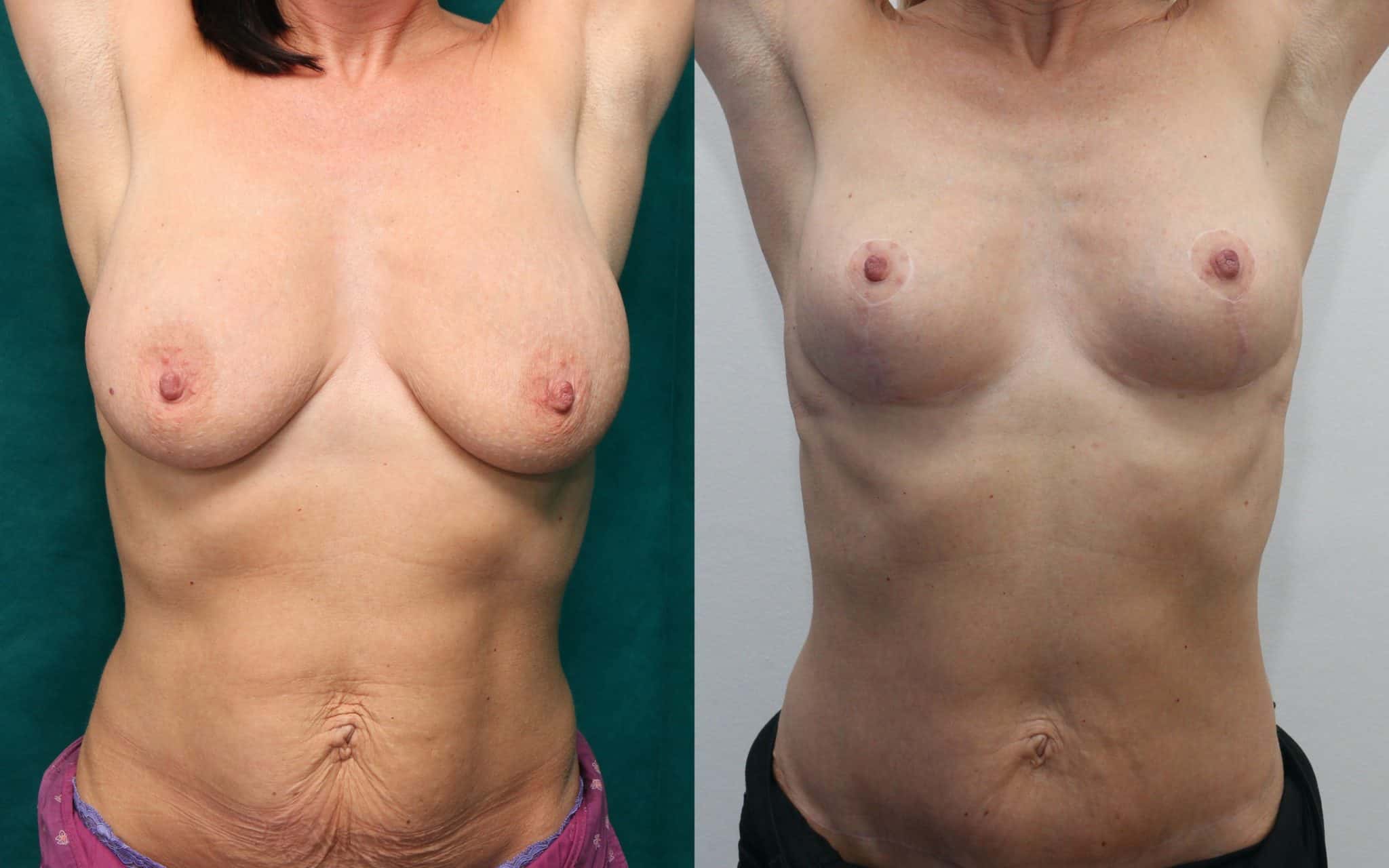 Mini tummy tuck and breast lift