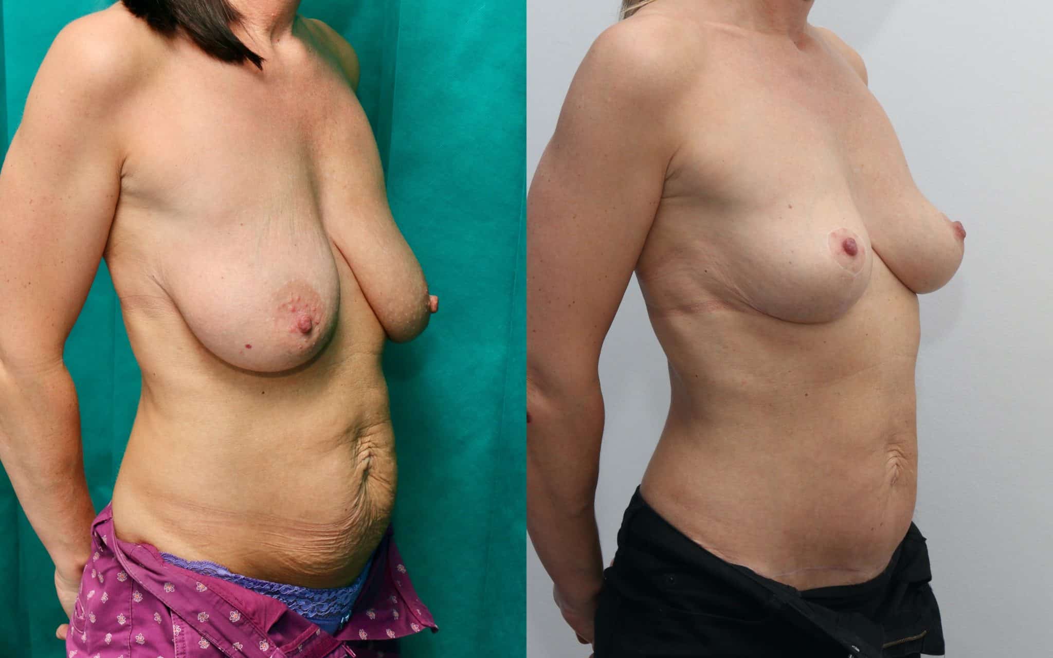 breast uplift before and after