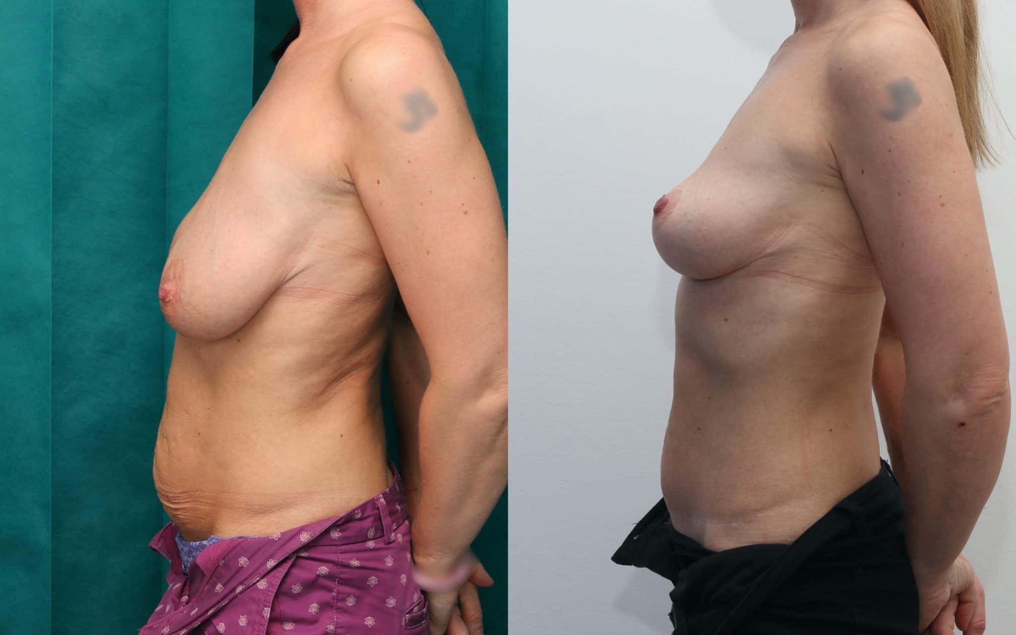 Mini tummy tuck and breast lift