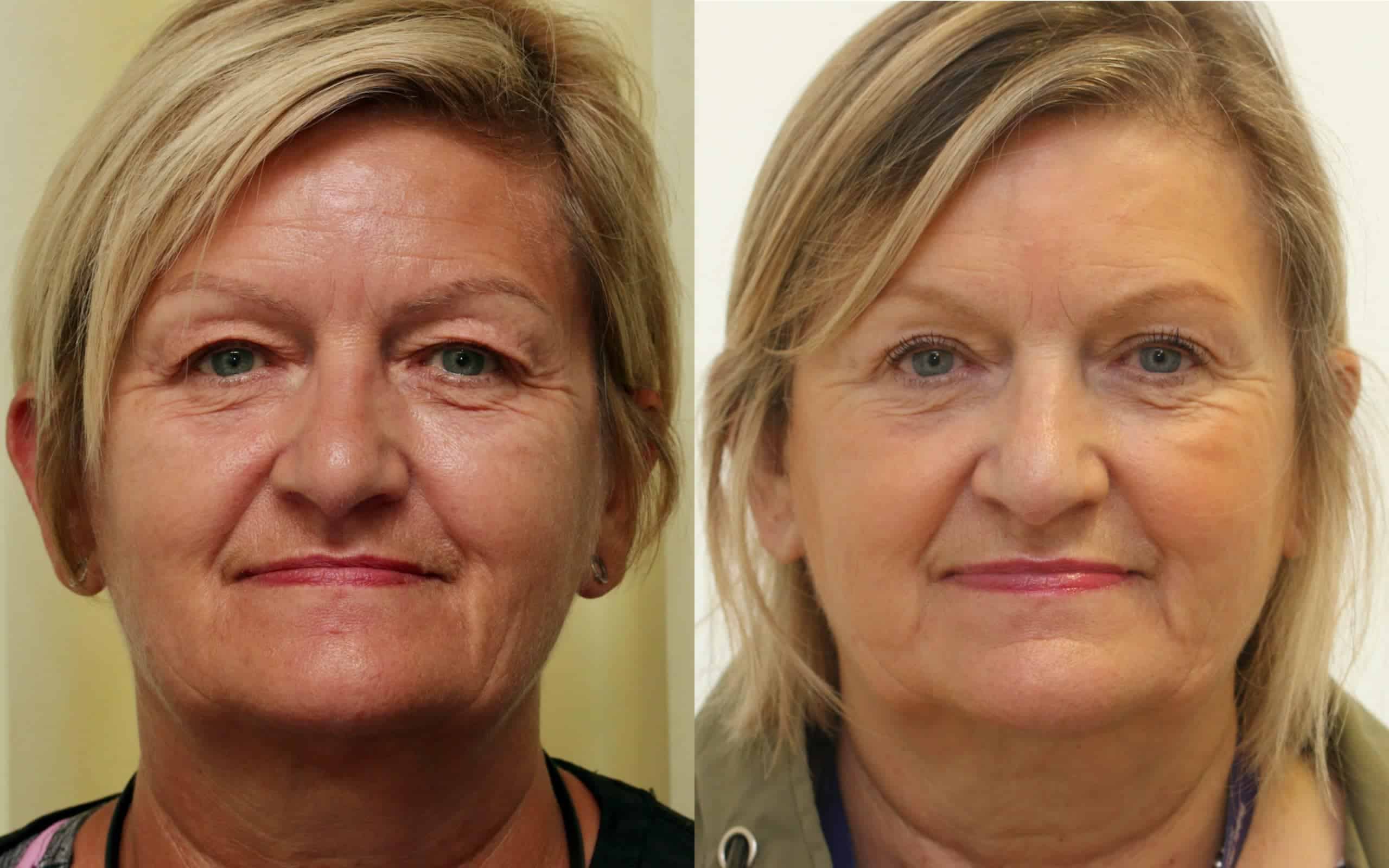 upper eyelid before and after
