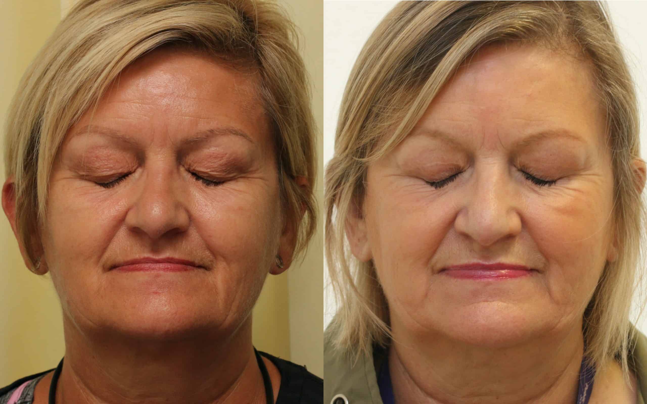 Upper eyelids surgery