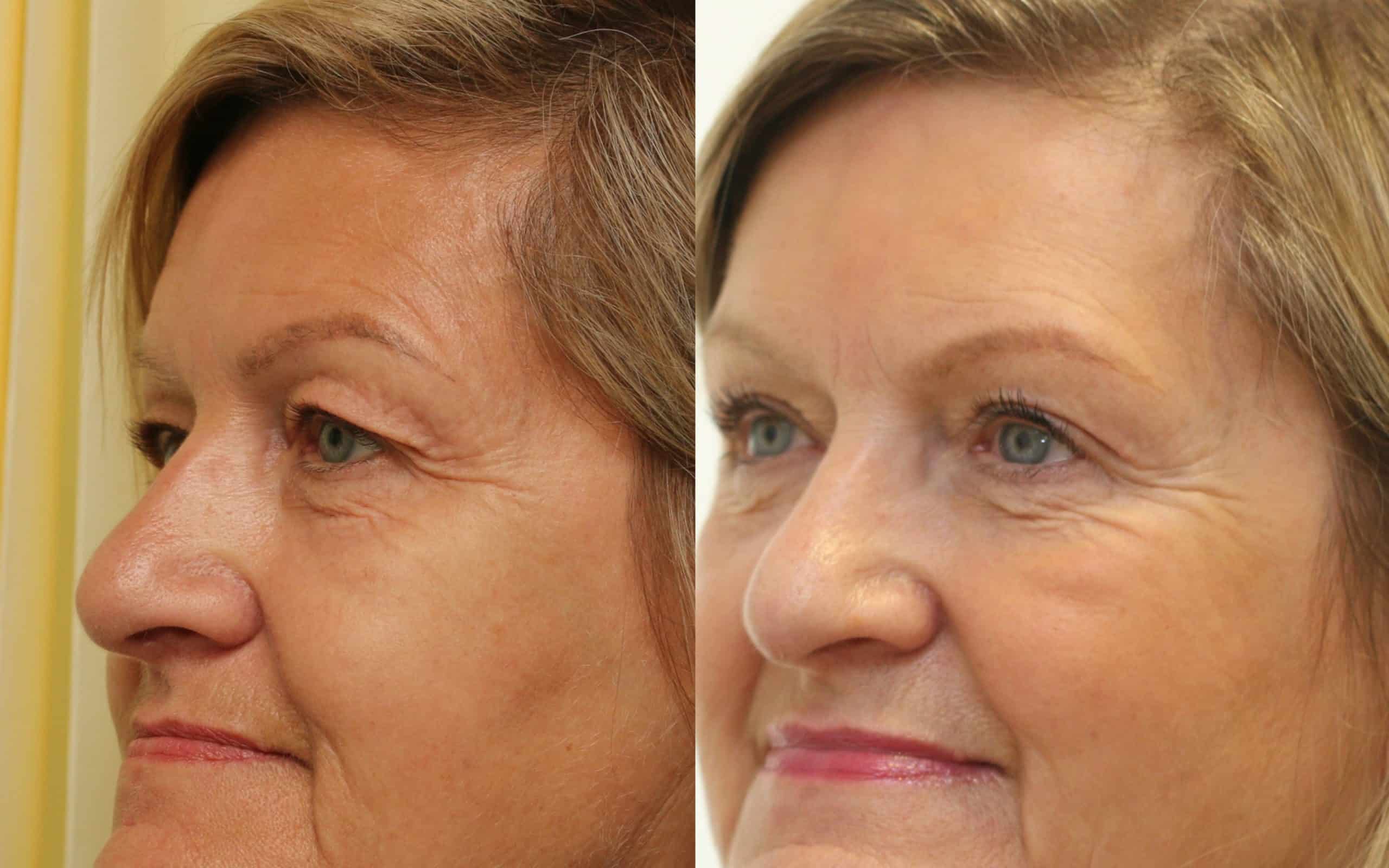 Upper eyelids surgery