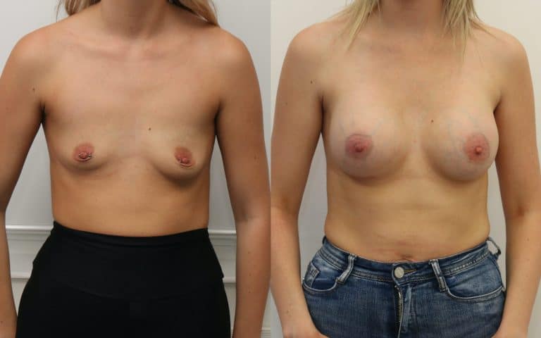 Breast augmentation post pregnancy before and after, photo 1 of 6