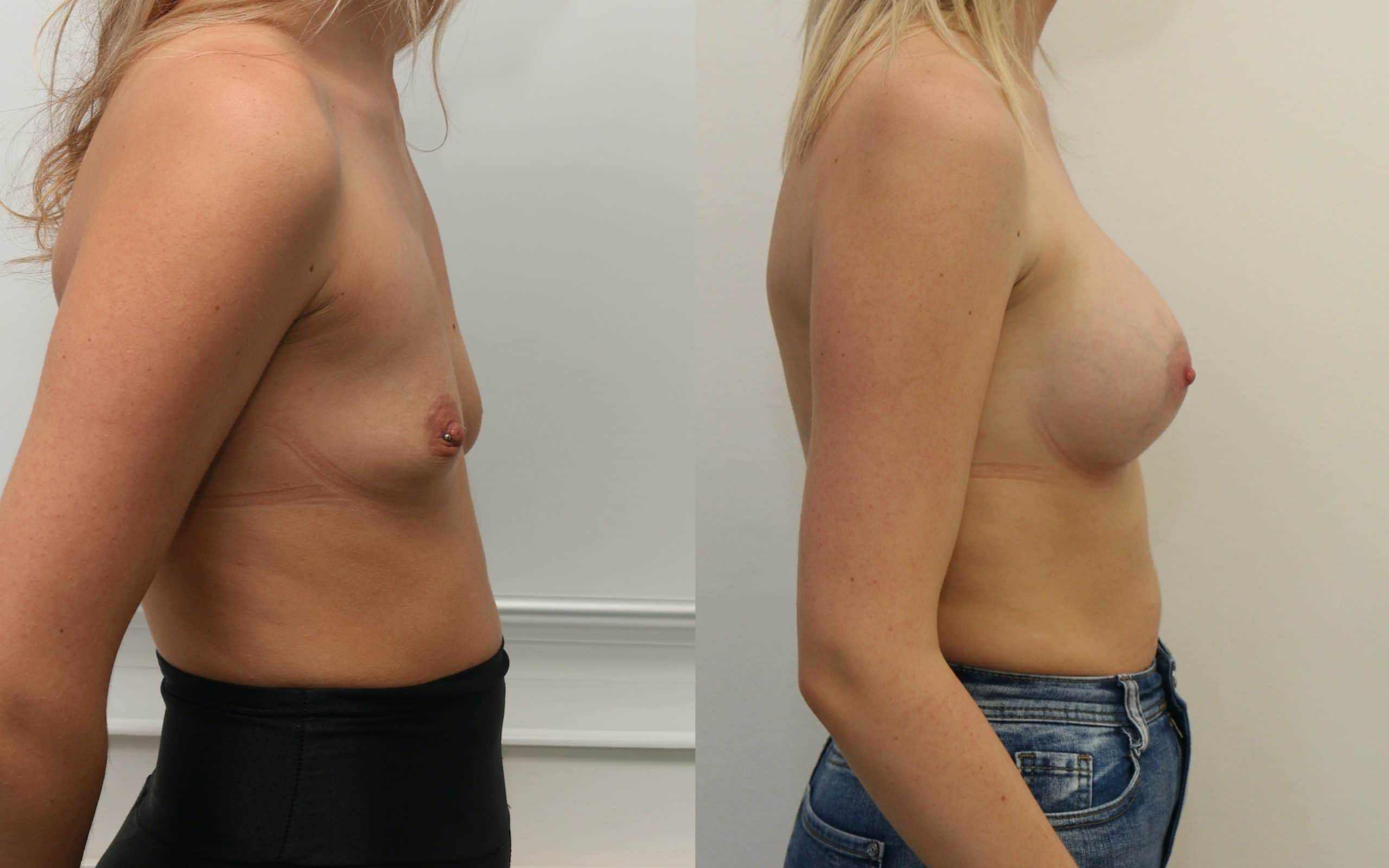 Breast implants 360cc