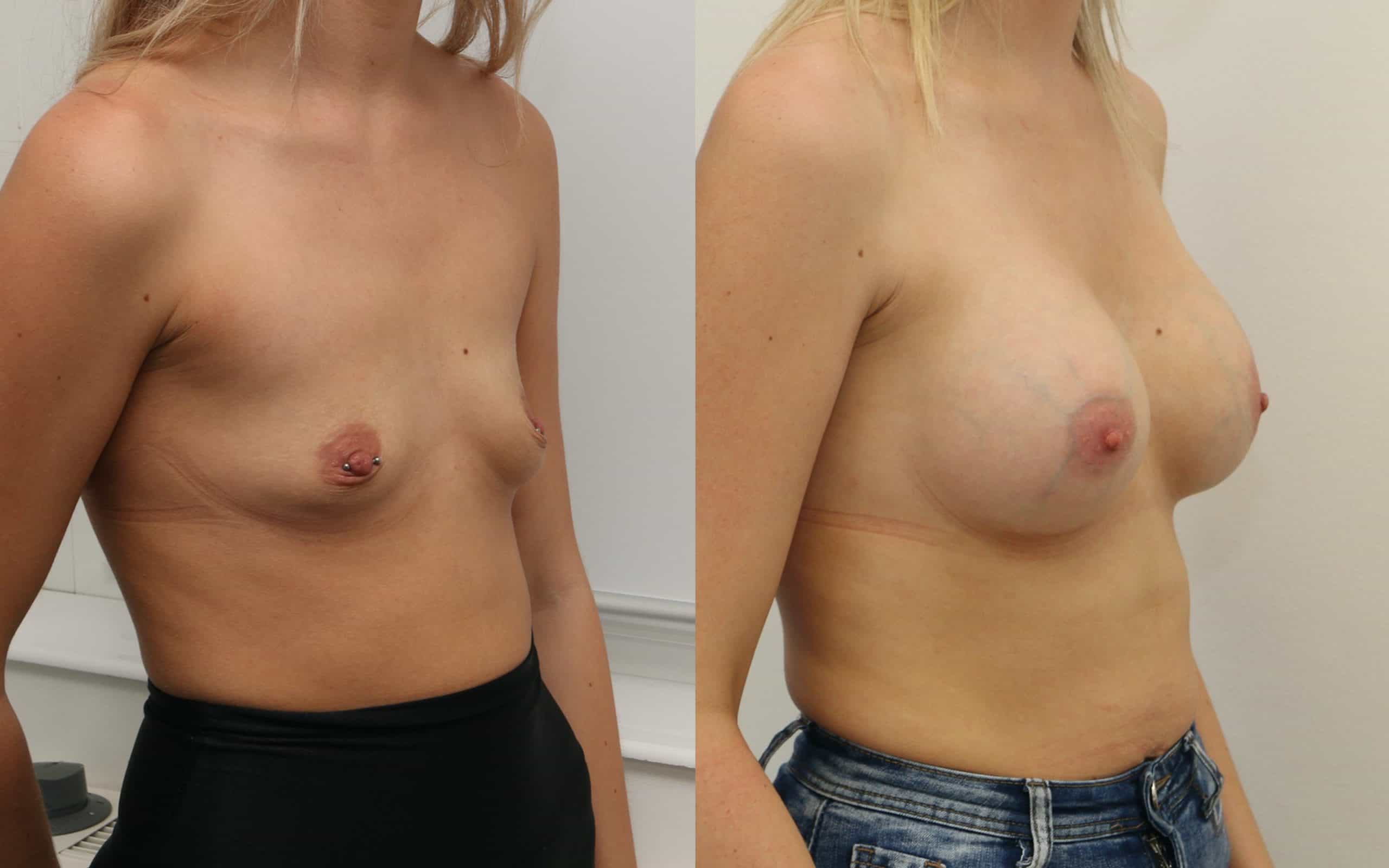 Breast implants 360cc