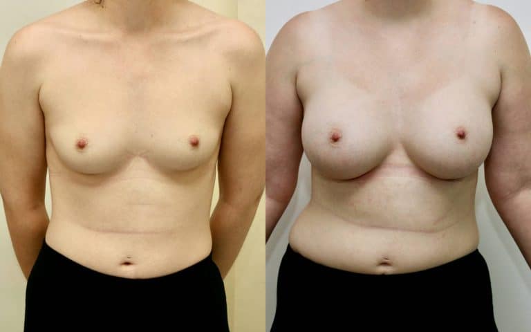 Breast augmentation before and after, case 12, photo 1 of 6