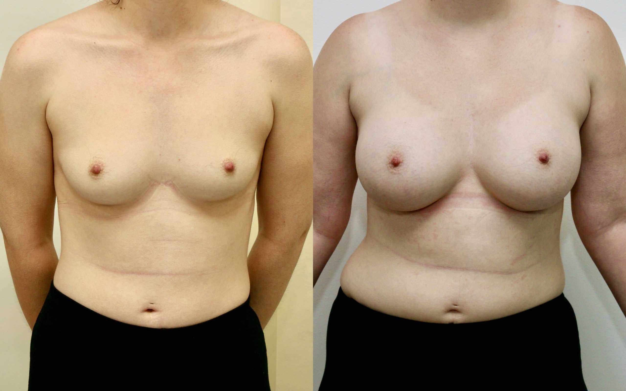 breast augmentation before and after