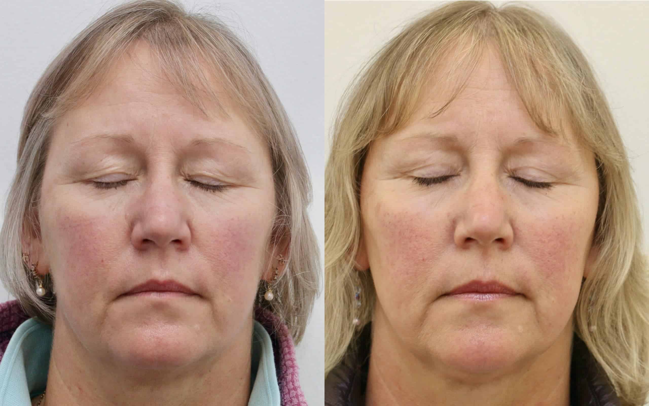 Upper eyelids surgery