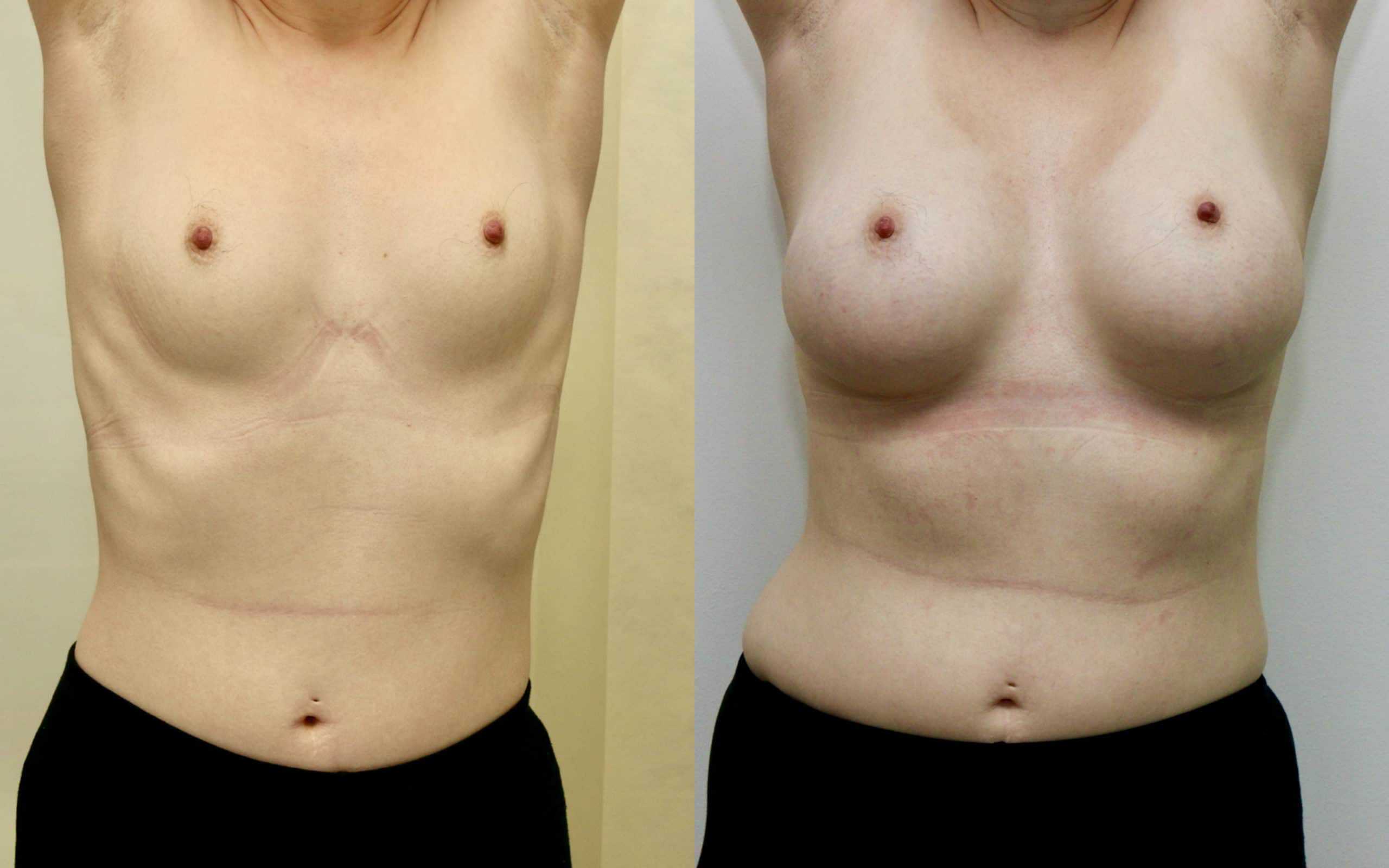 330cc breast implants below the muscle 1.5 years post op