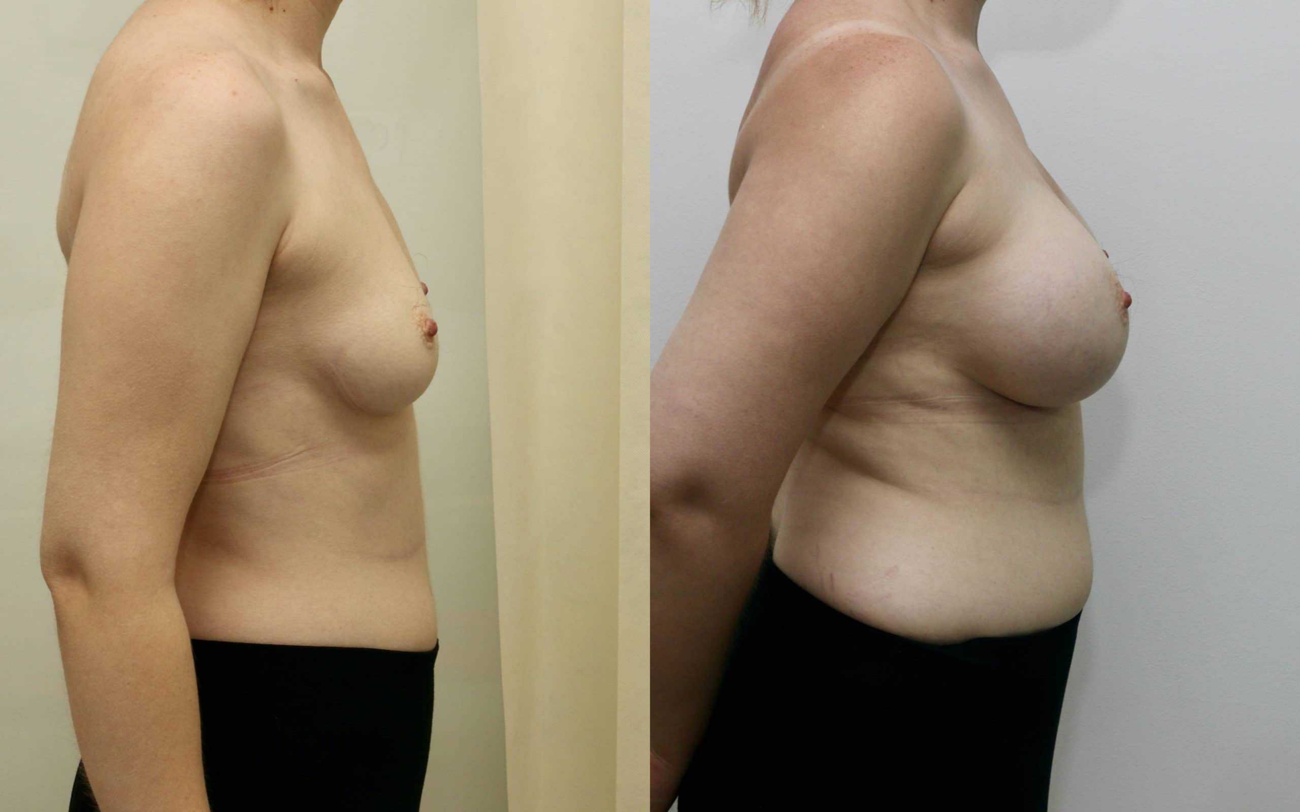 330cc breast implants below the muscle 1.5 years post op