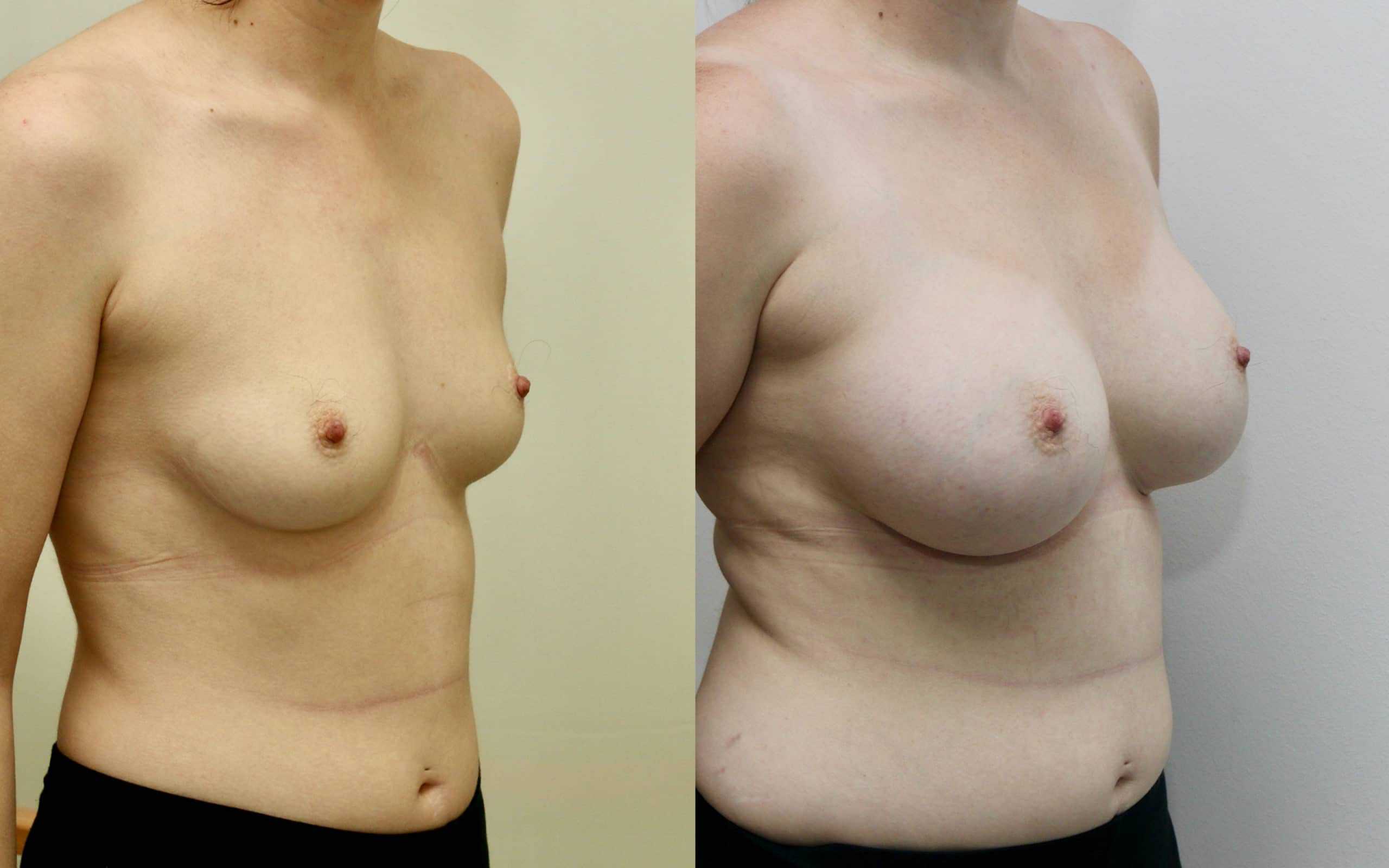 330cc breast implants below the muscle 1.5 years post op