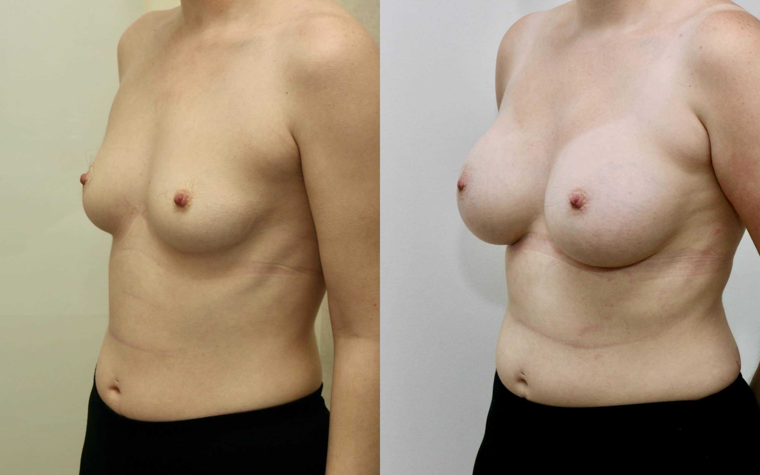 330cc breast implants below the muscle 1.5 years post op