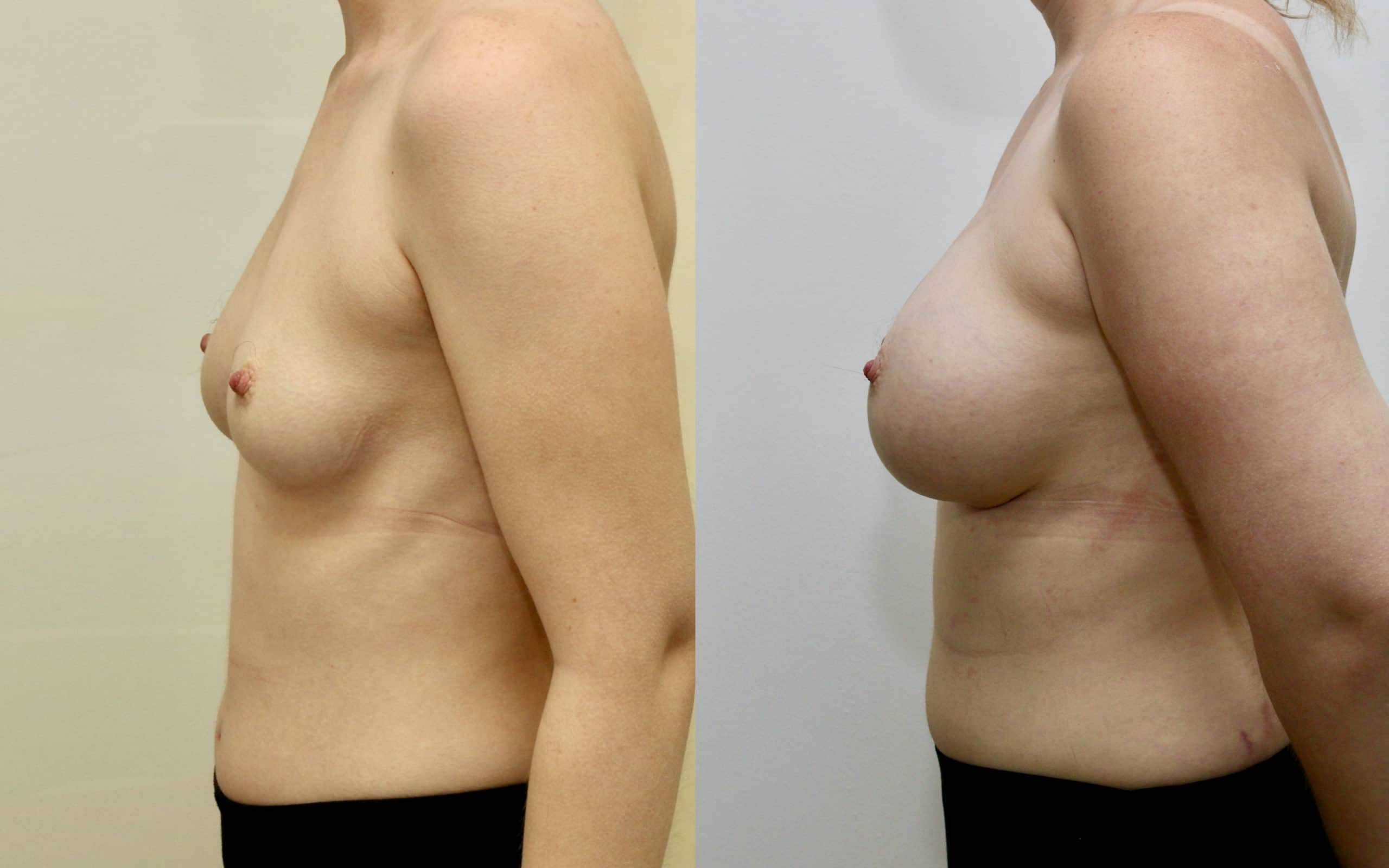 330cc breast implants below the muscle 1.5 years post op