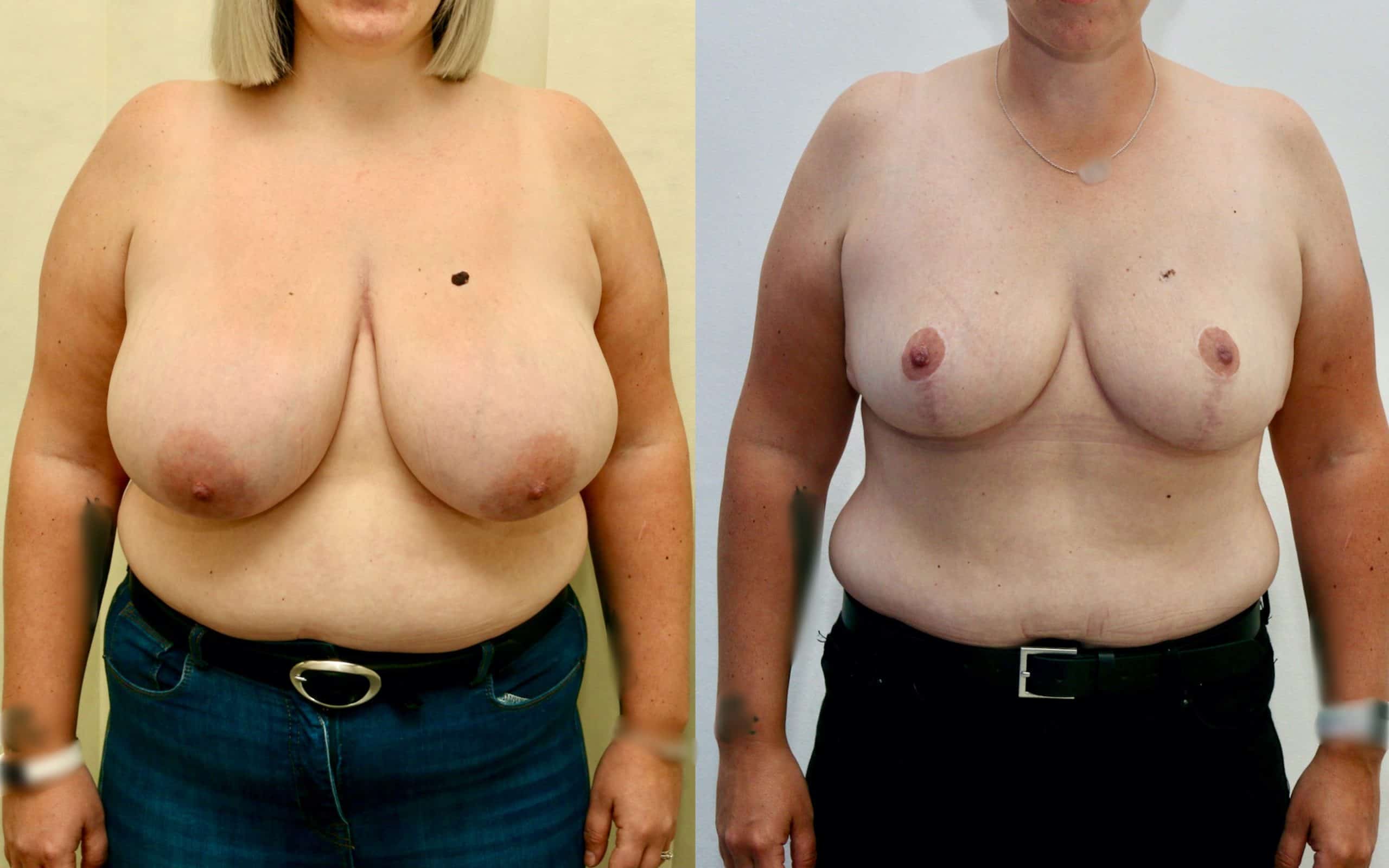 Breast reduction