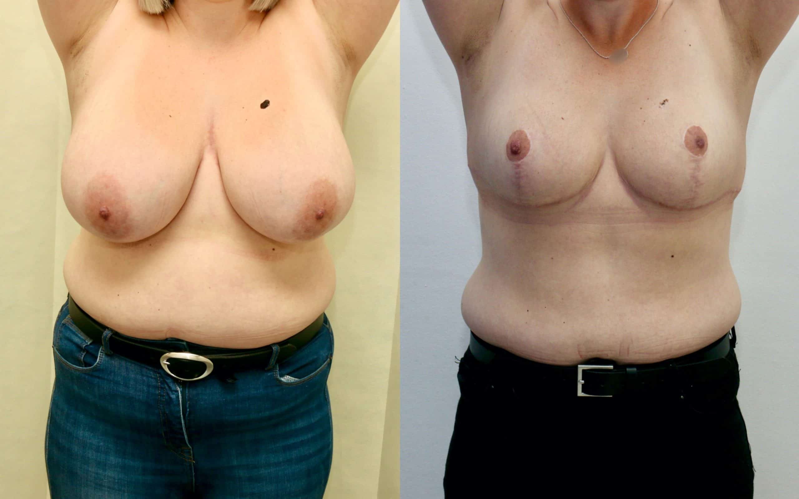 Breast reduction