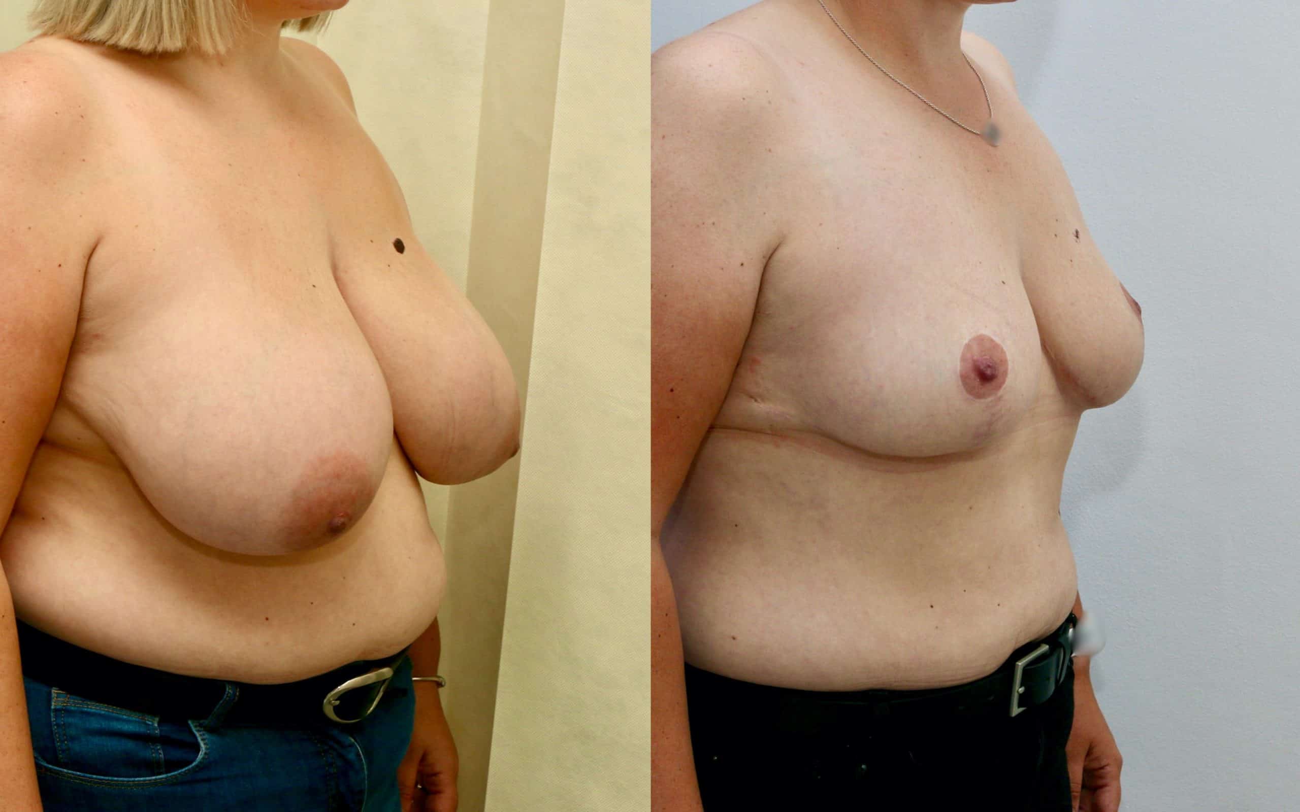 Breast reduction