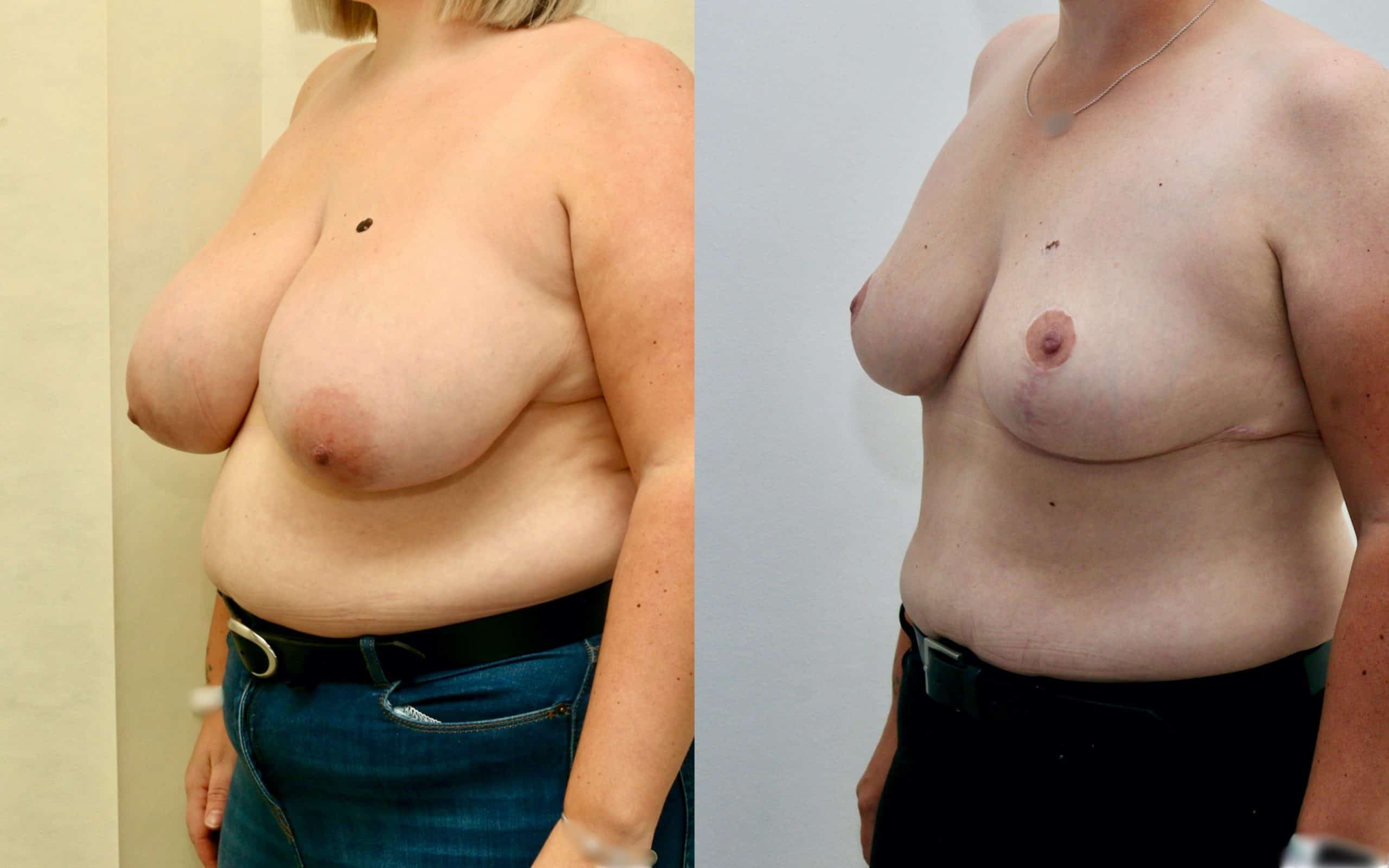 Breast reduction