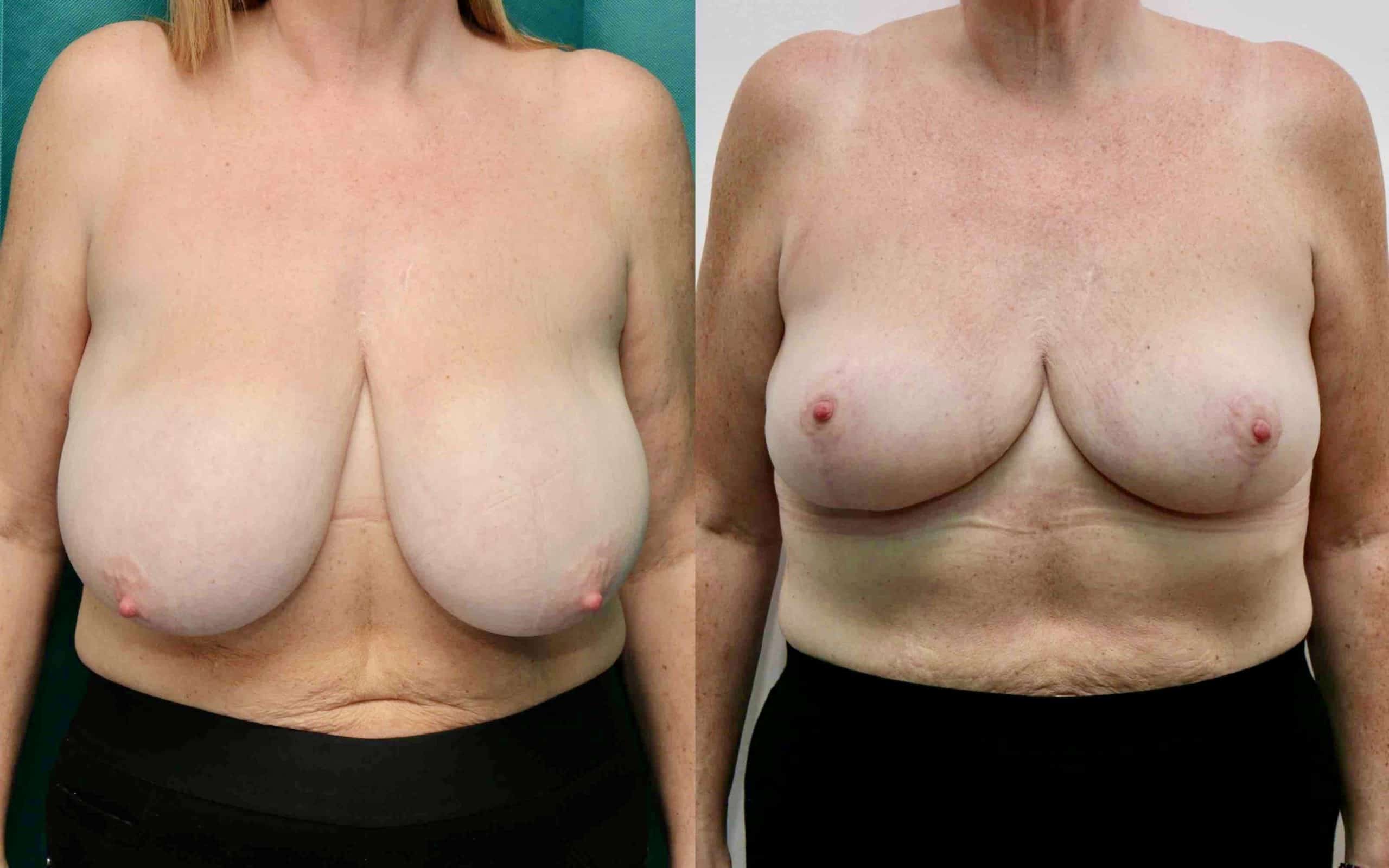 Breast reduction