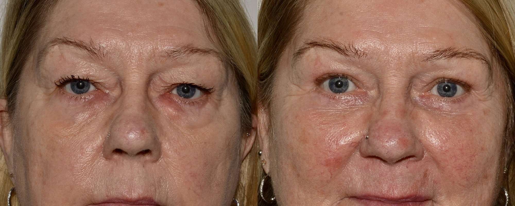 Upper and lower blepharoplasty