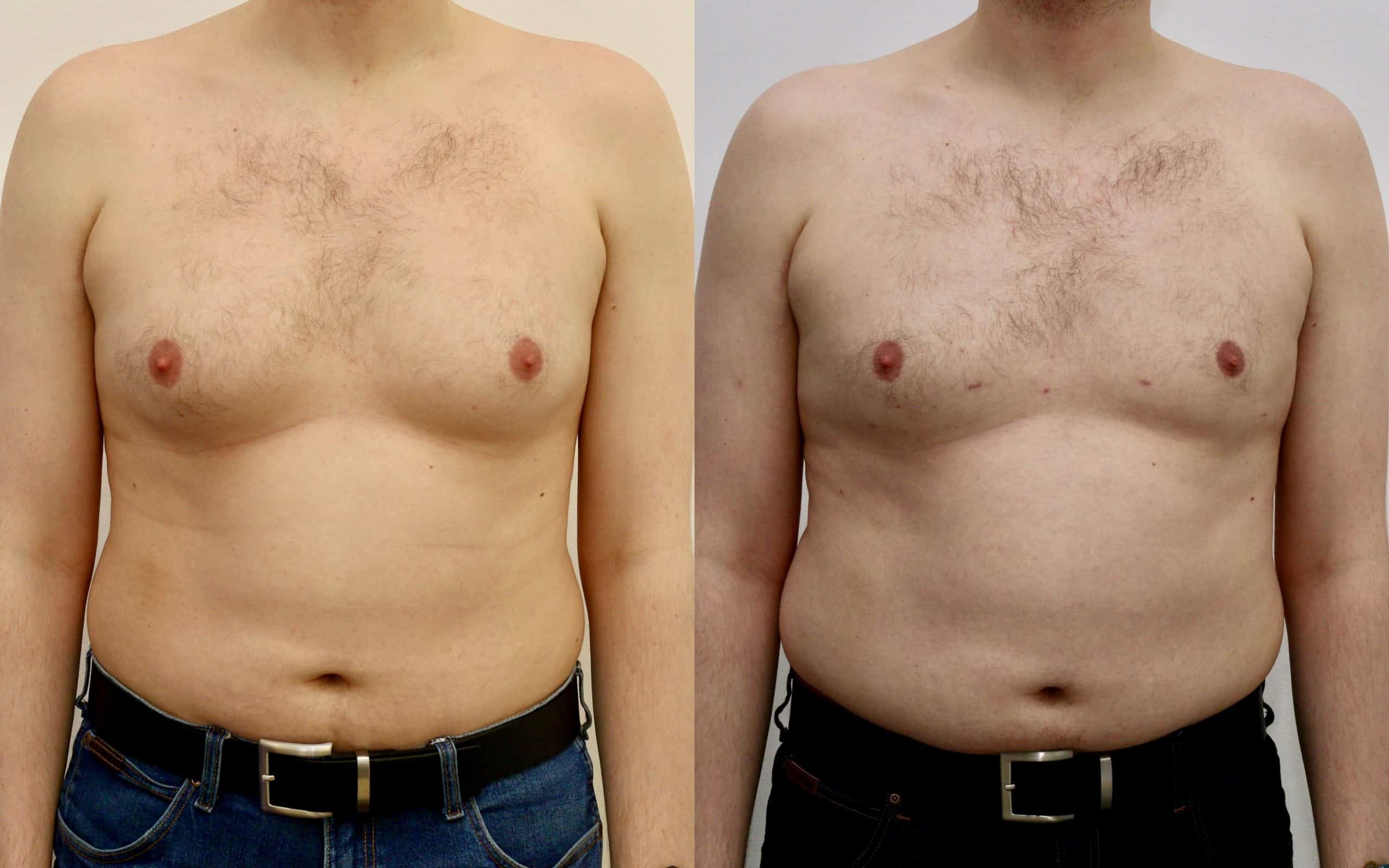 Gynecomastia liposuction before and after