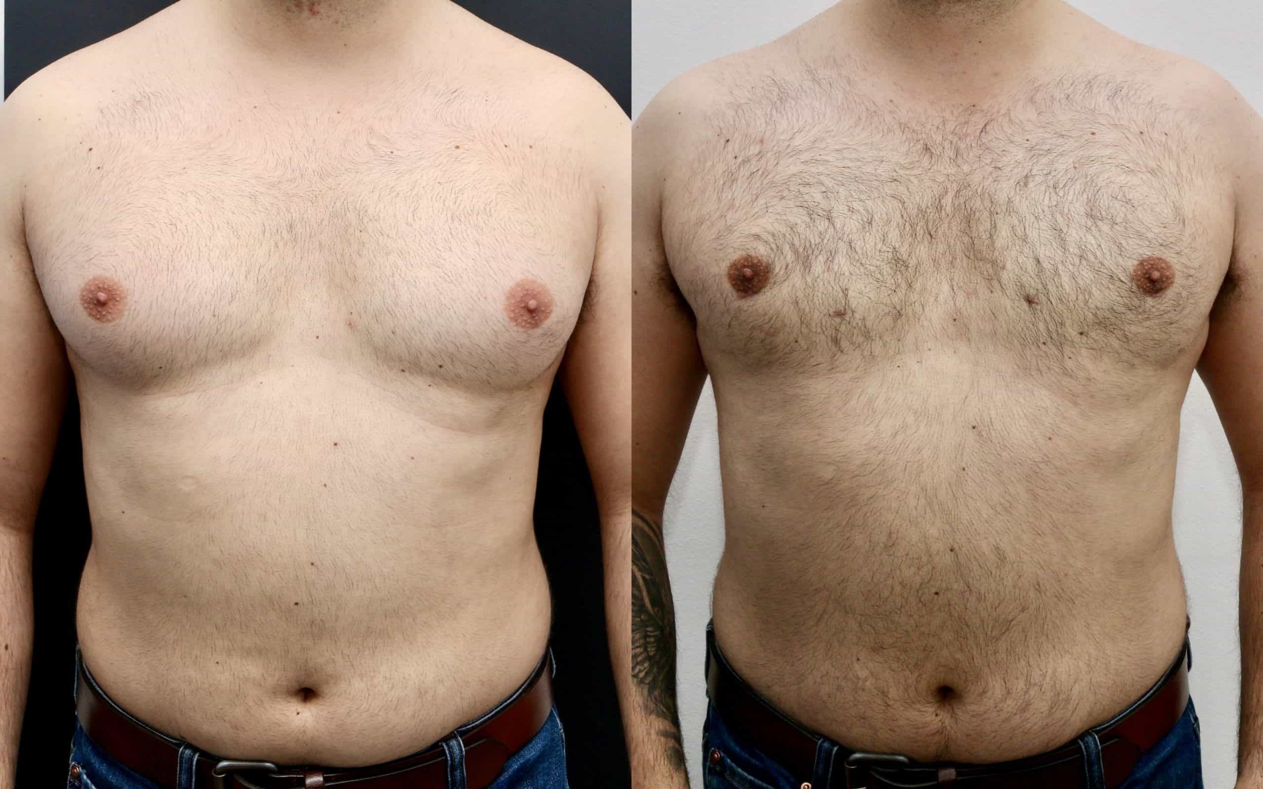 Male breast reduction before and after