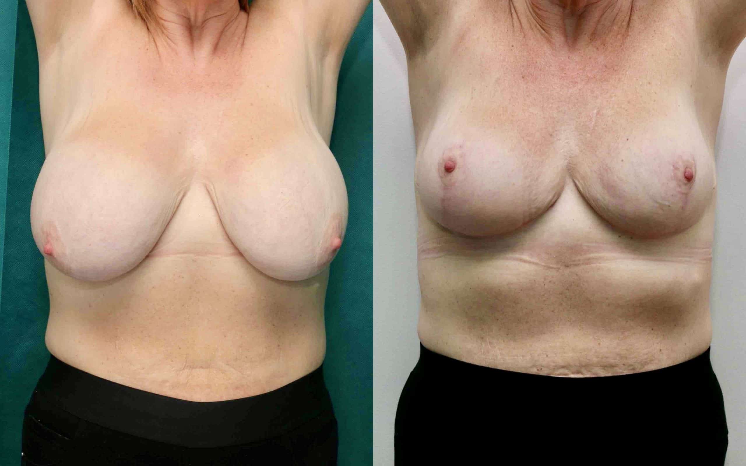 Breast reduction