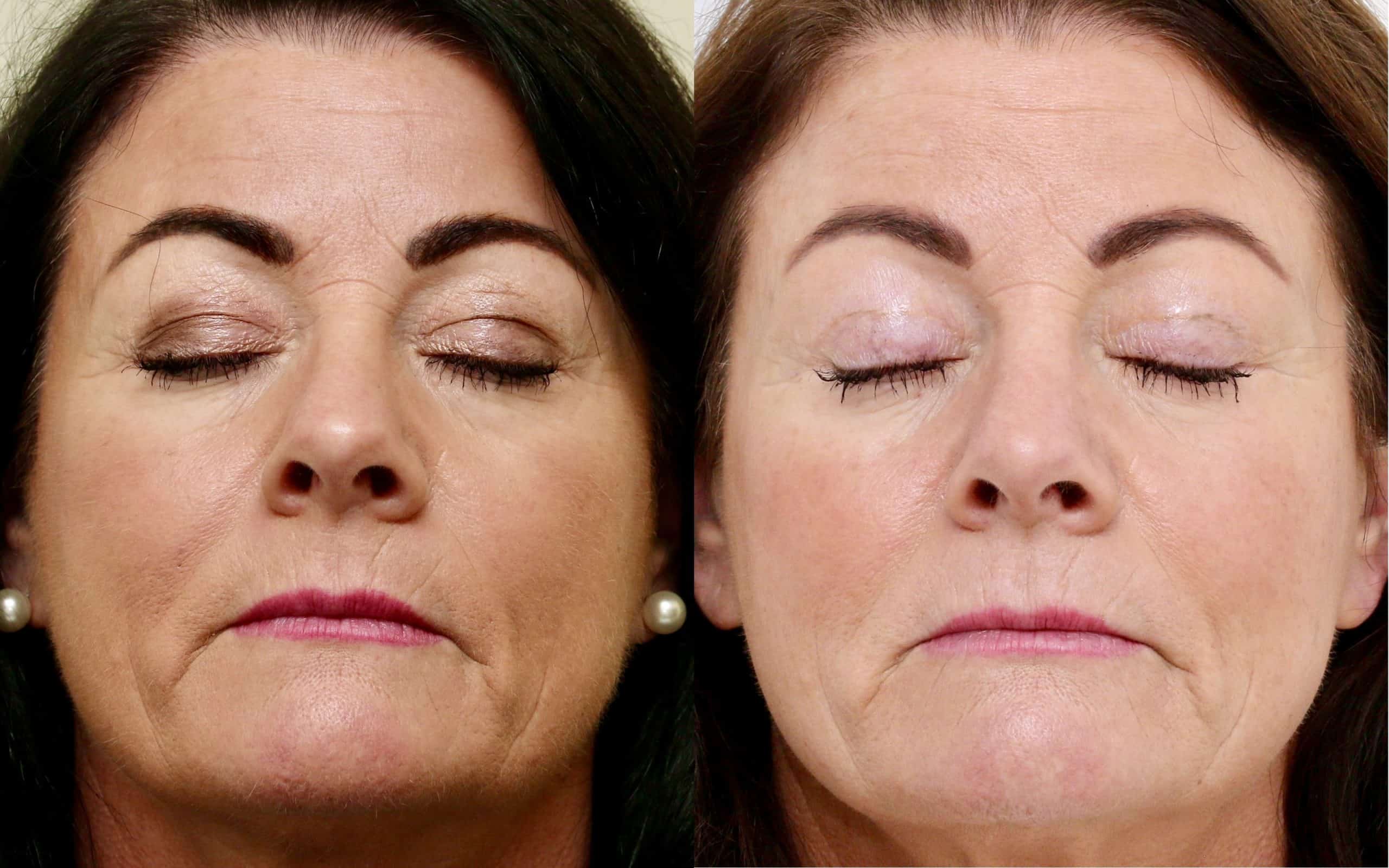 Eyelid surgery with fat transfer