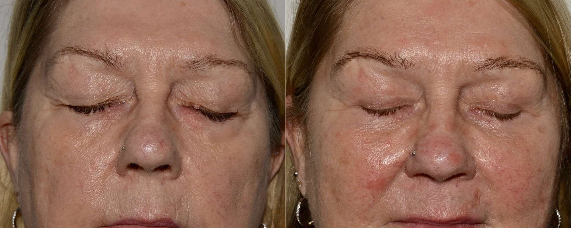 Upper and lower blepharoplasty