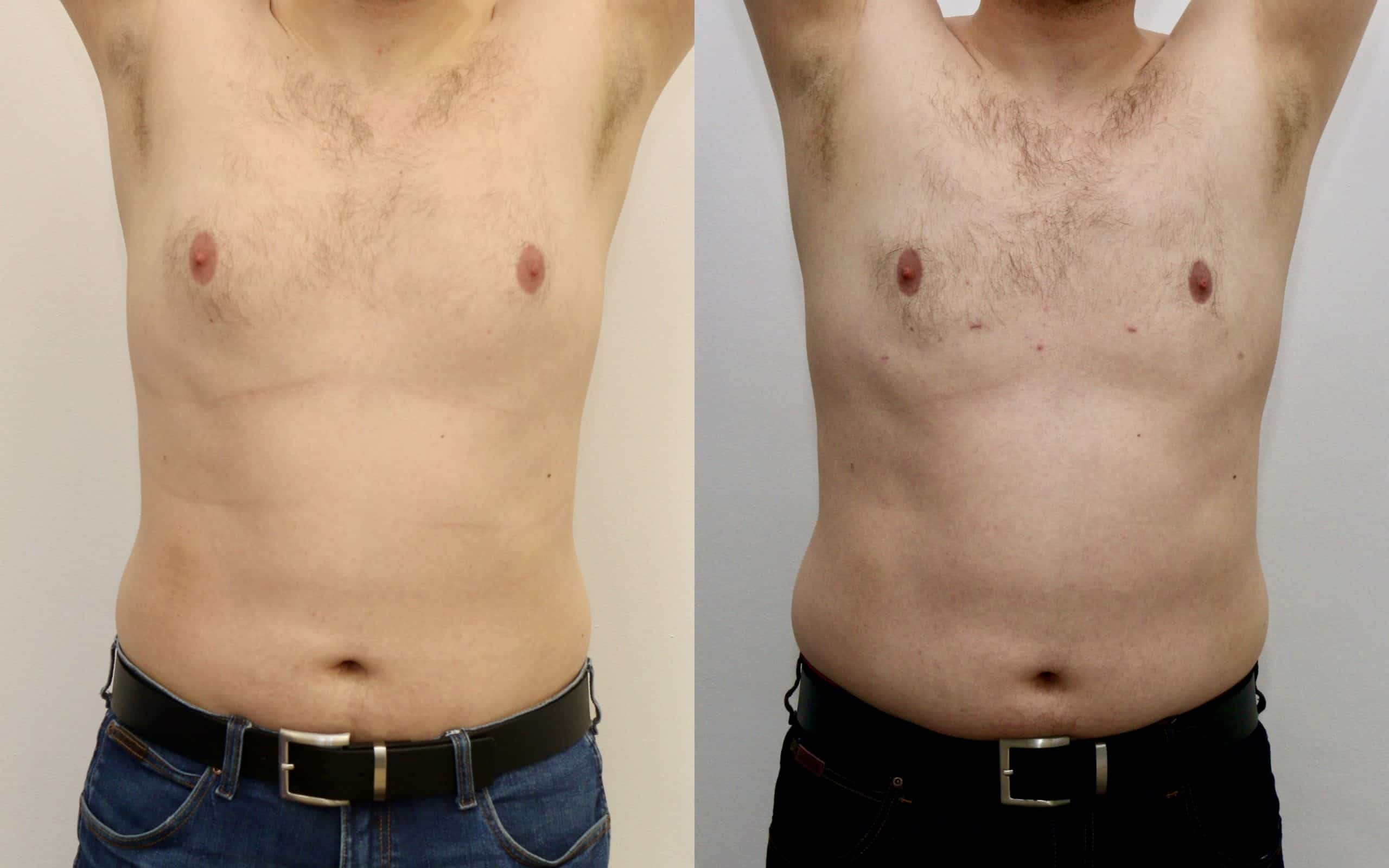 Gynecomastia liposuction before and after