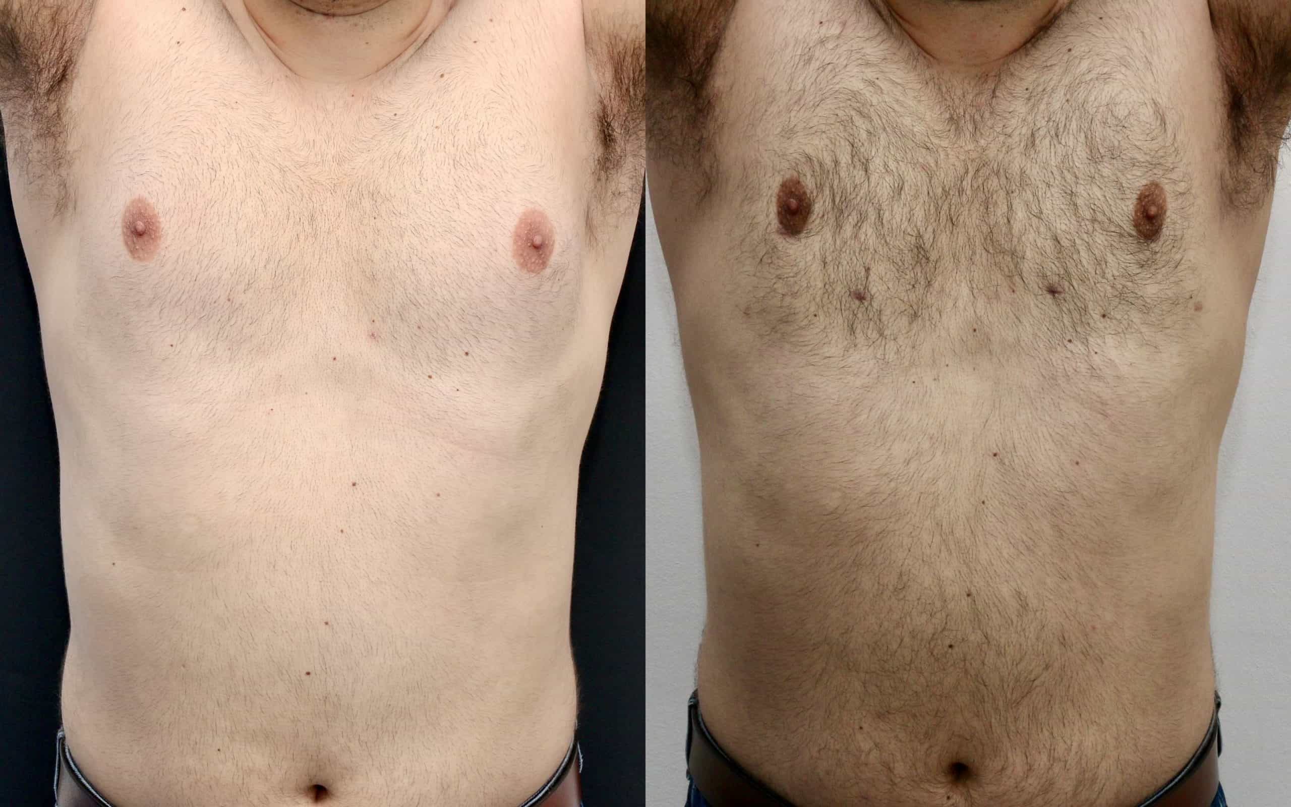 Male breast reduction before and after