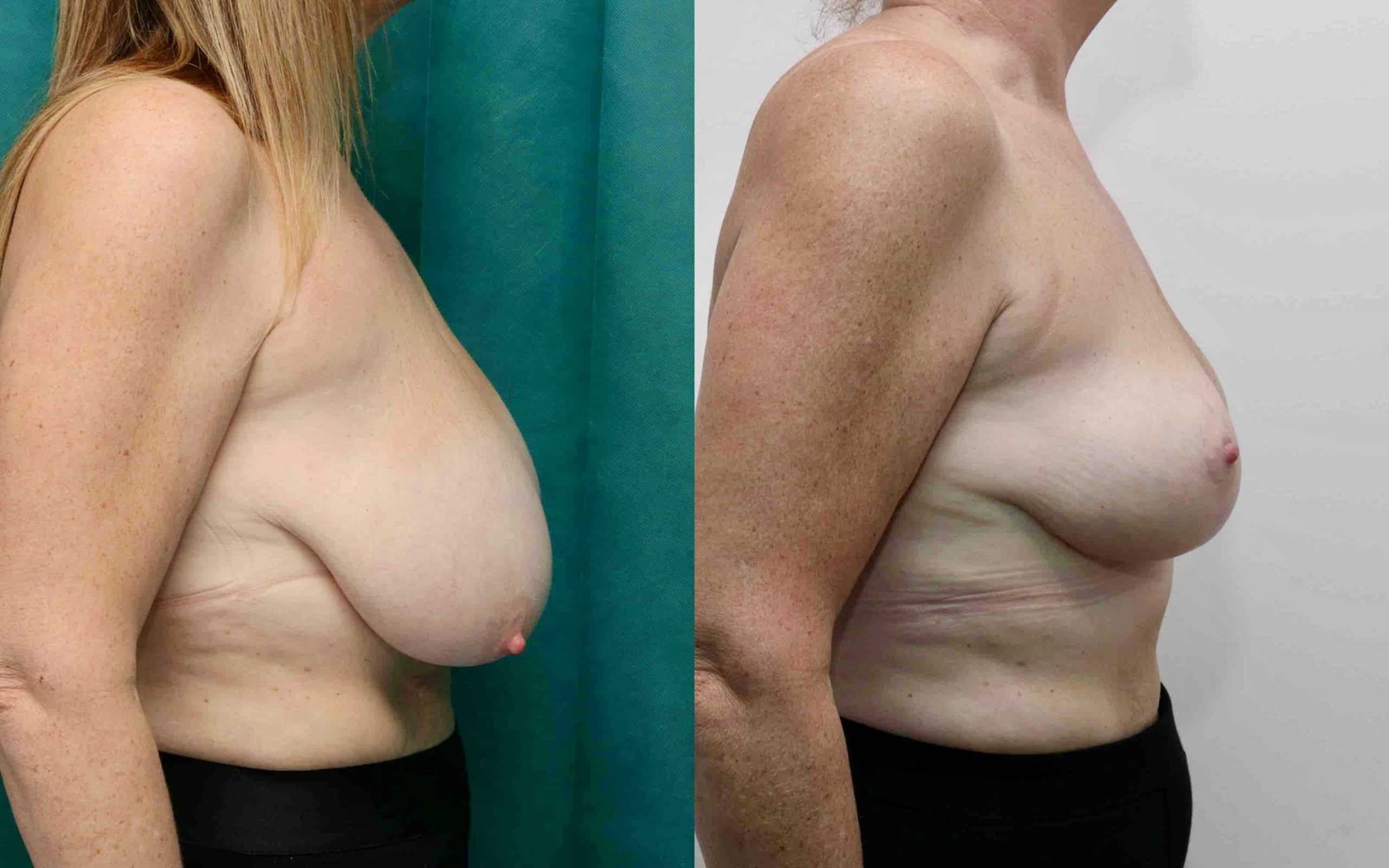 Breast reduction