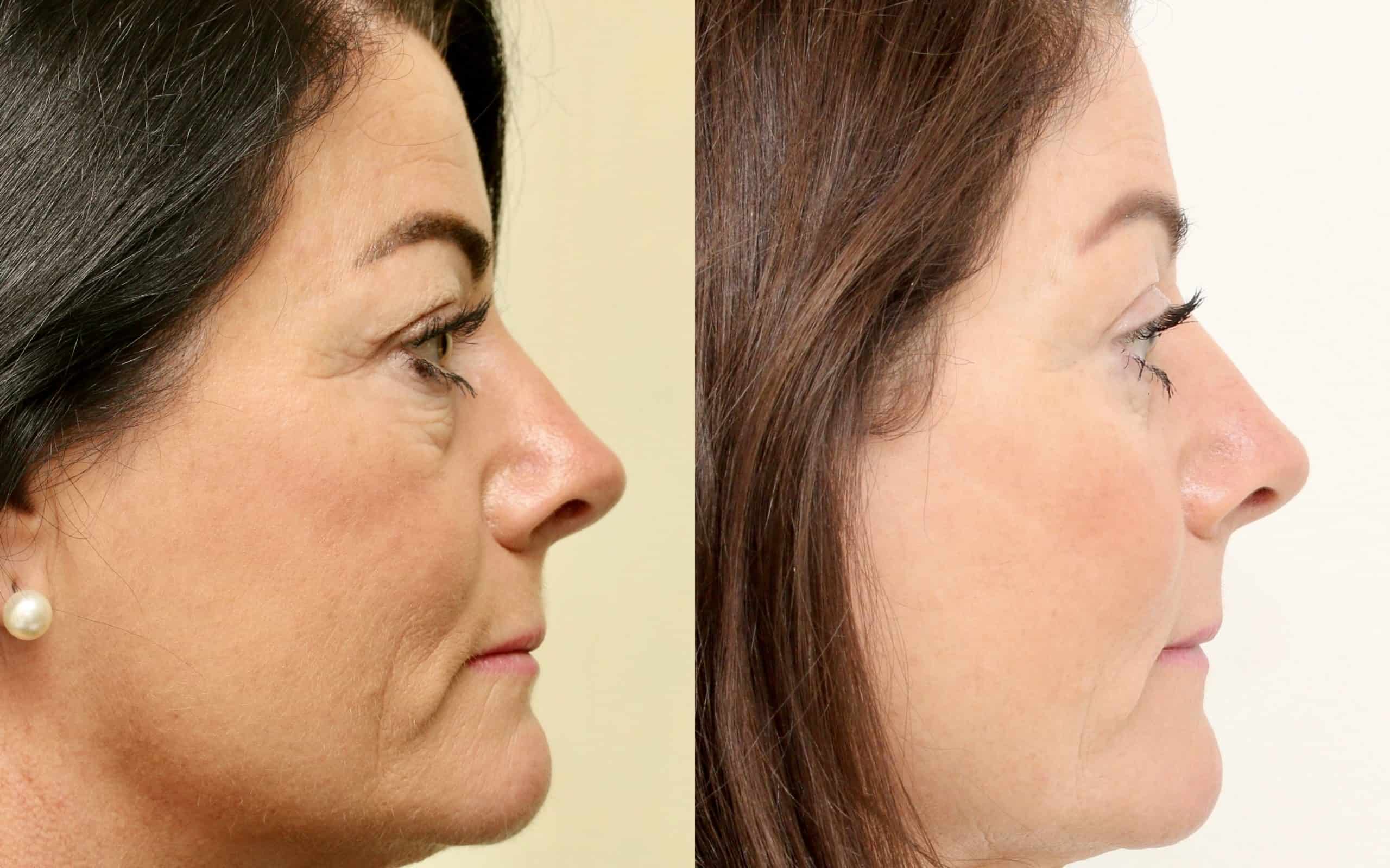 Eyelid surgery with fat transfer