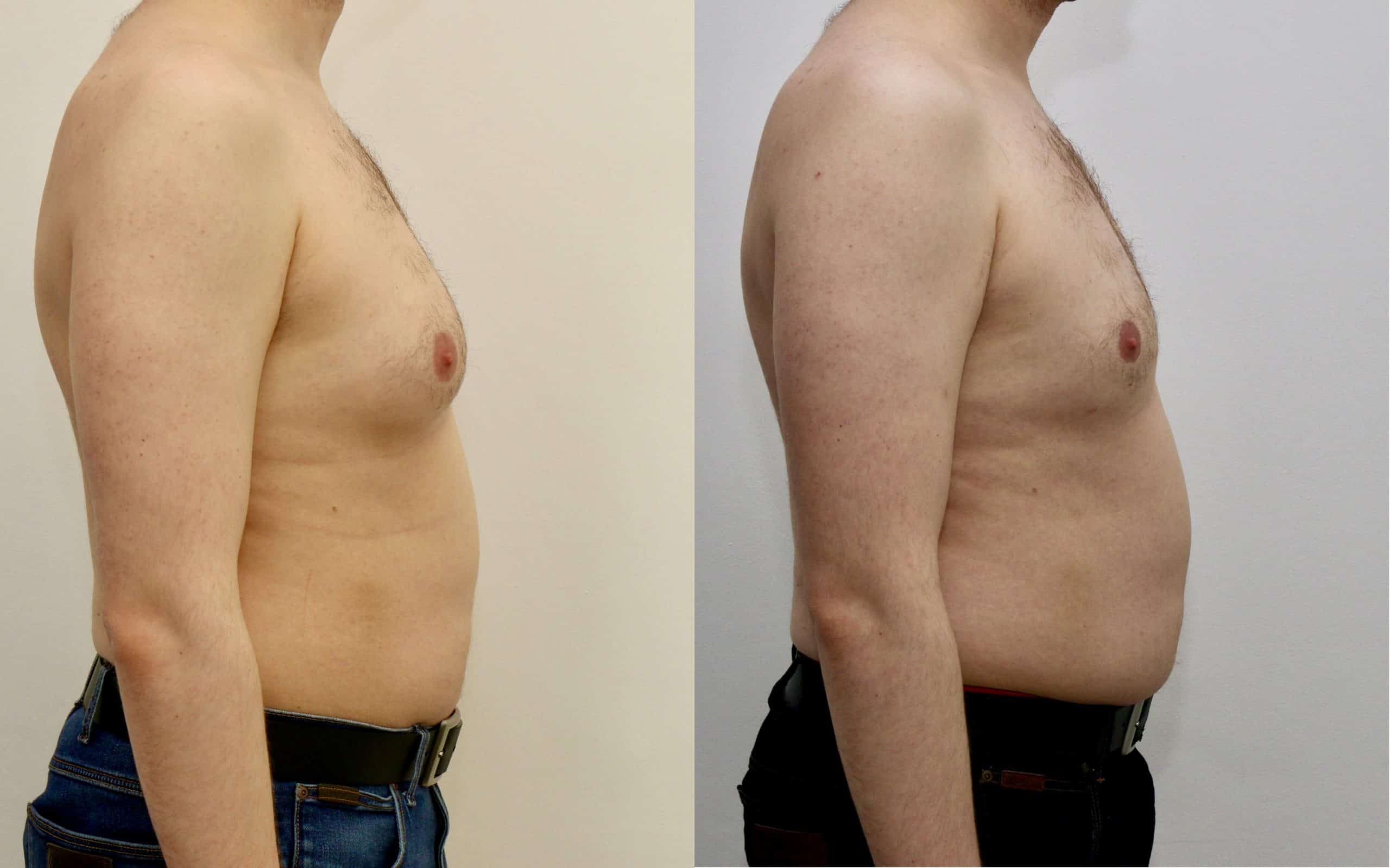 Gynecomastia liposuction before and after