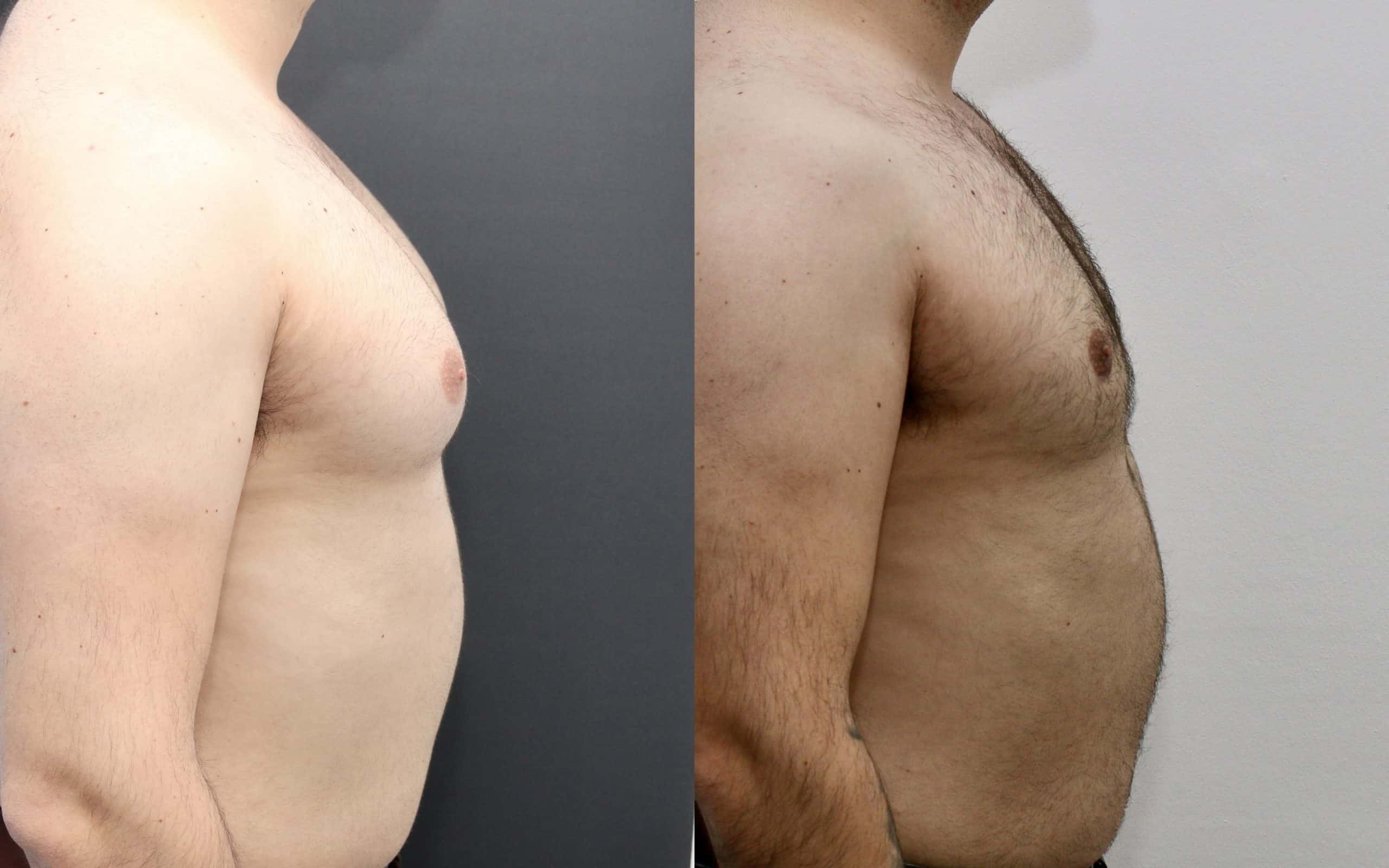 Male breast reduction before and after