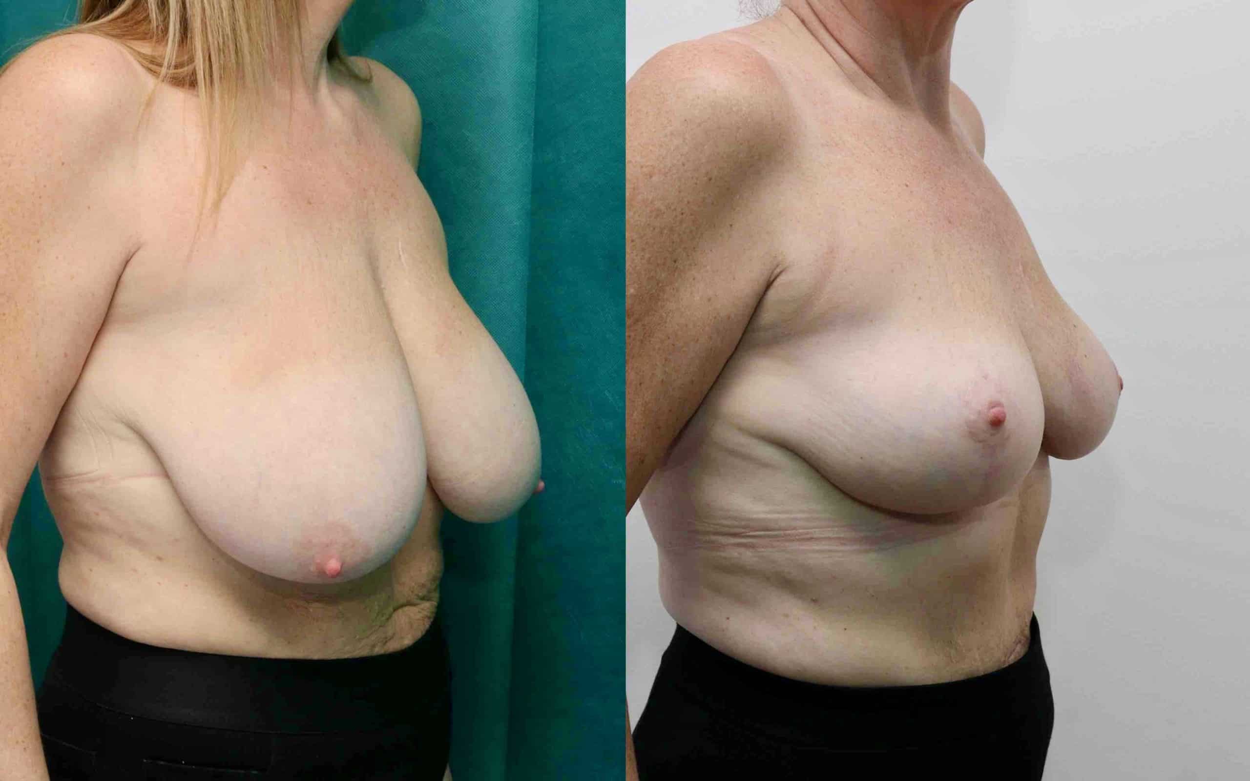 Breast reduction