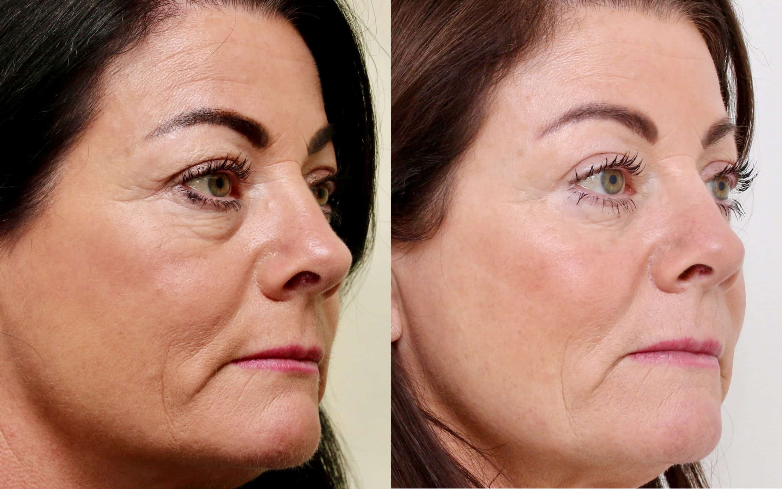 Eyelid surgery with fat transfer